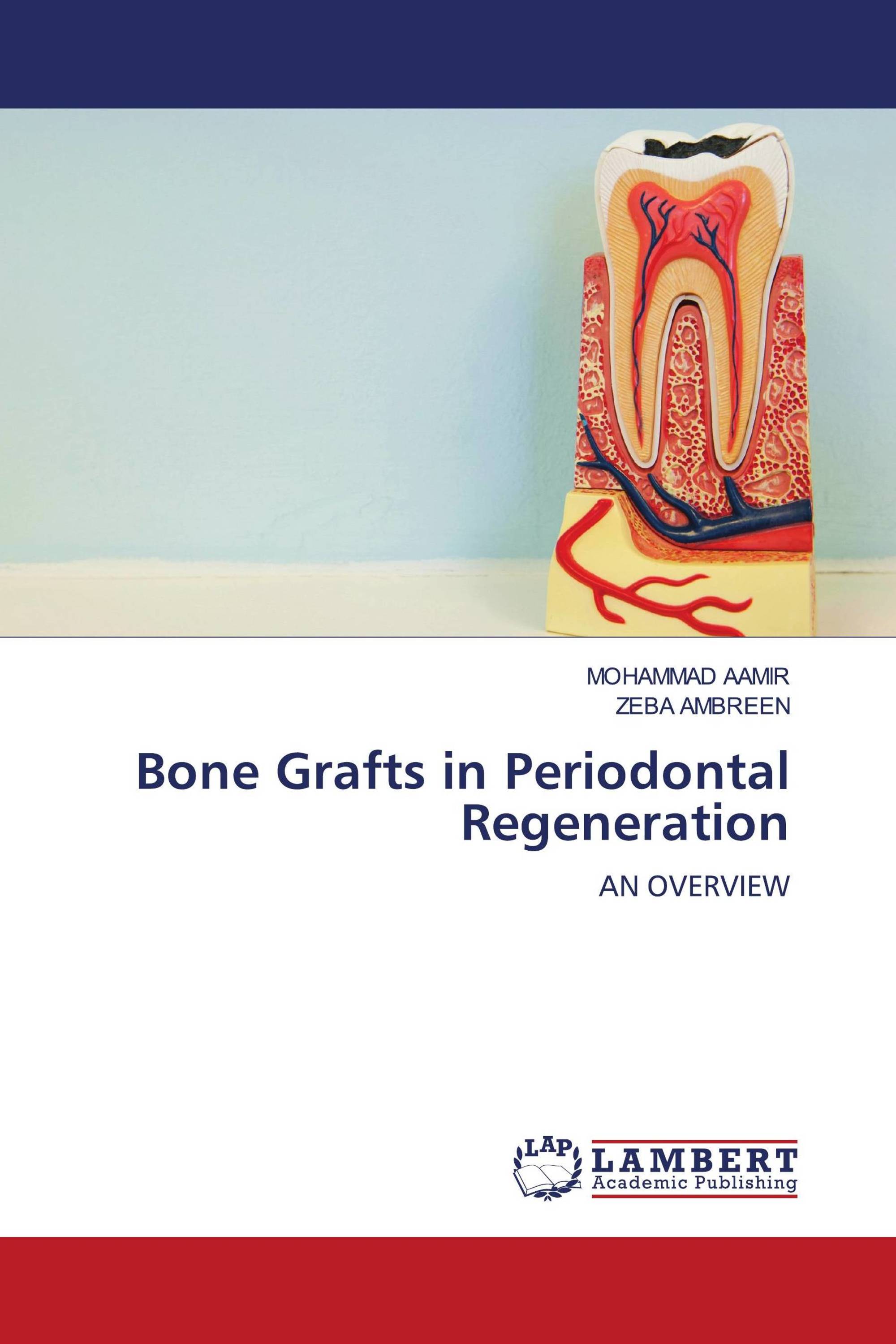 Bone Grafts in Periodontal Regeneration