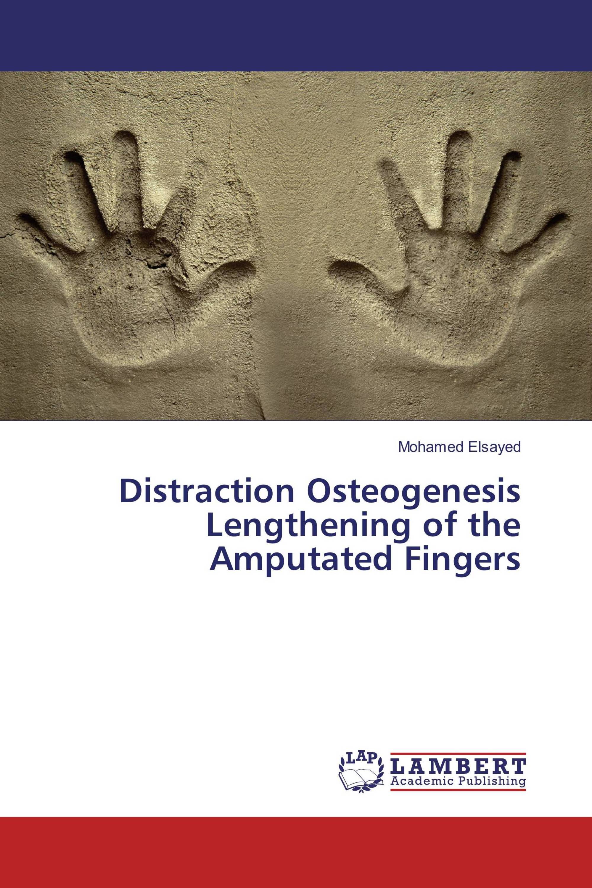 Distraction Osteogenesis Lengthening of the Amputated Fingers