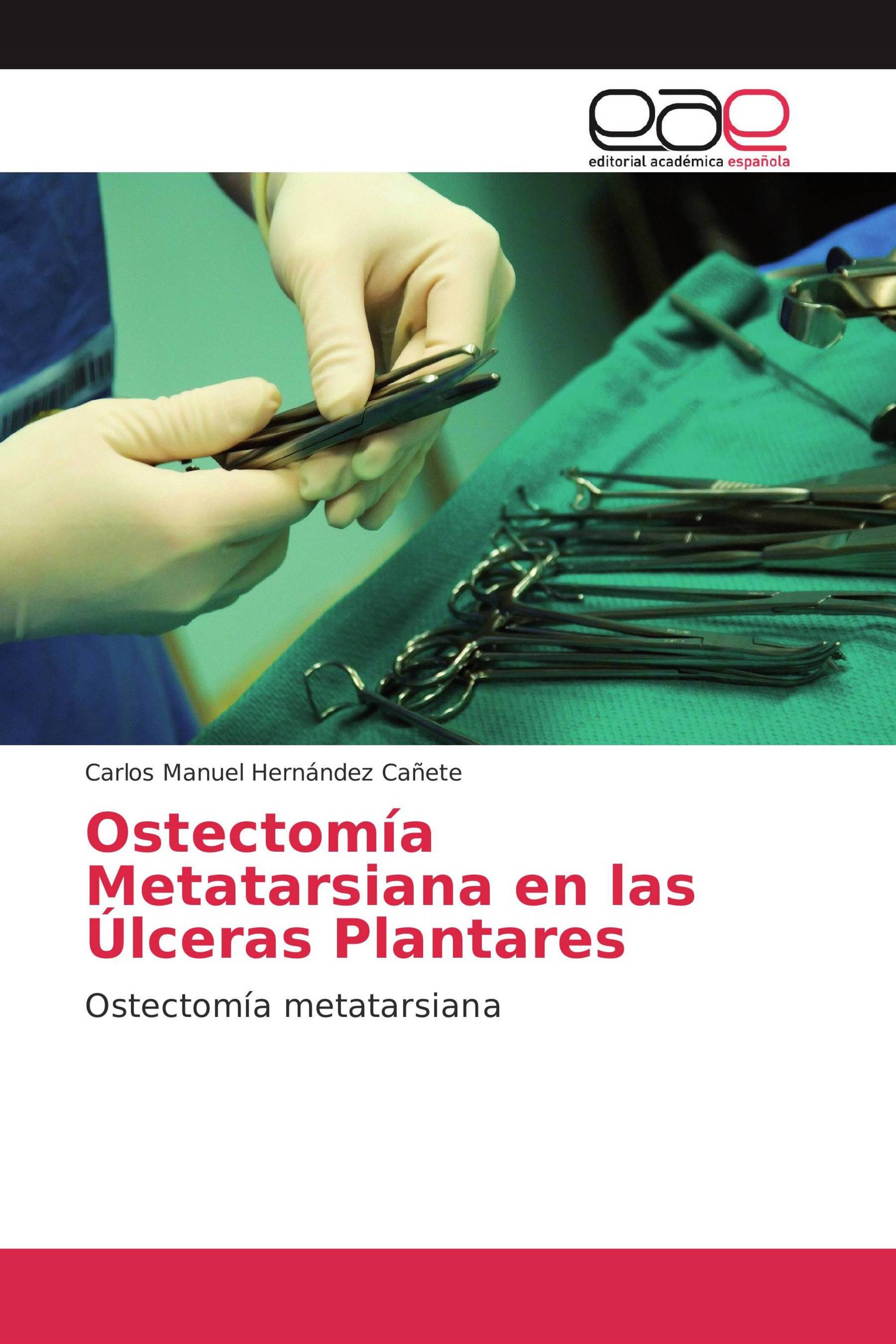 Ostectomía Metatarsiana en las Úlceras Plantares