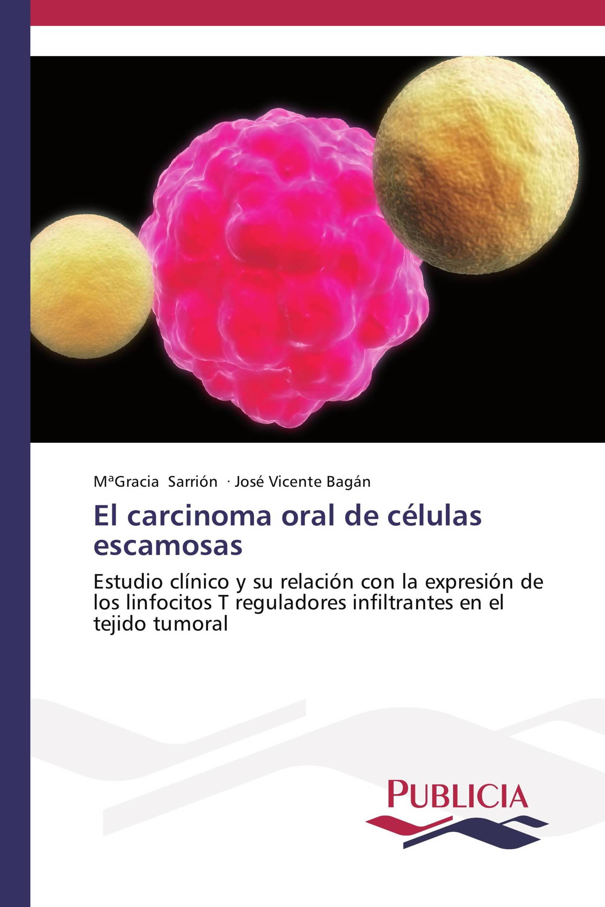 El carcinoma oral de células escamosas