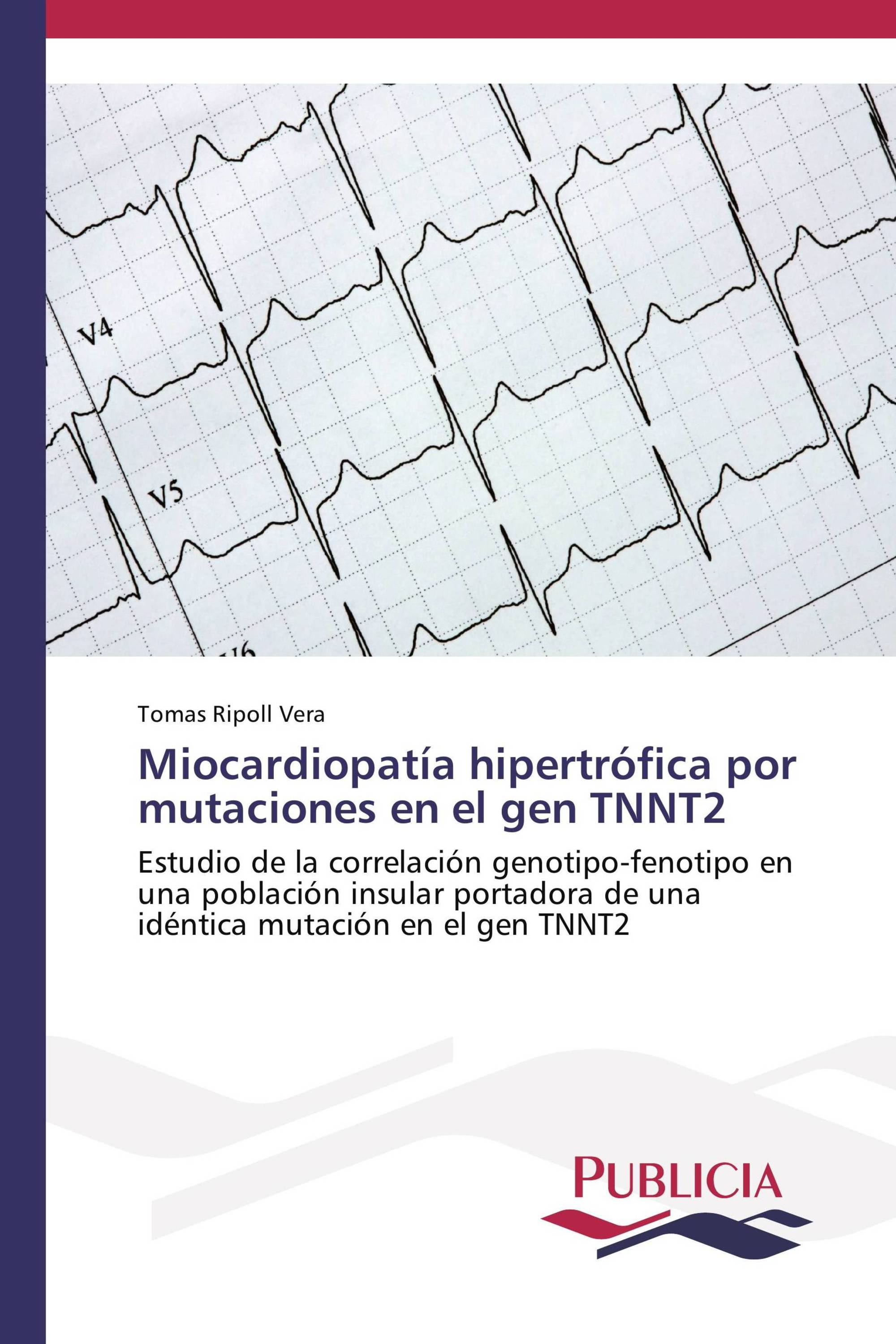 Miocardiopatía hipertrófica por mutaciones en el gen TNNT2