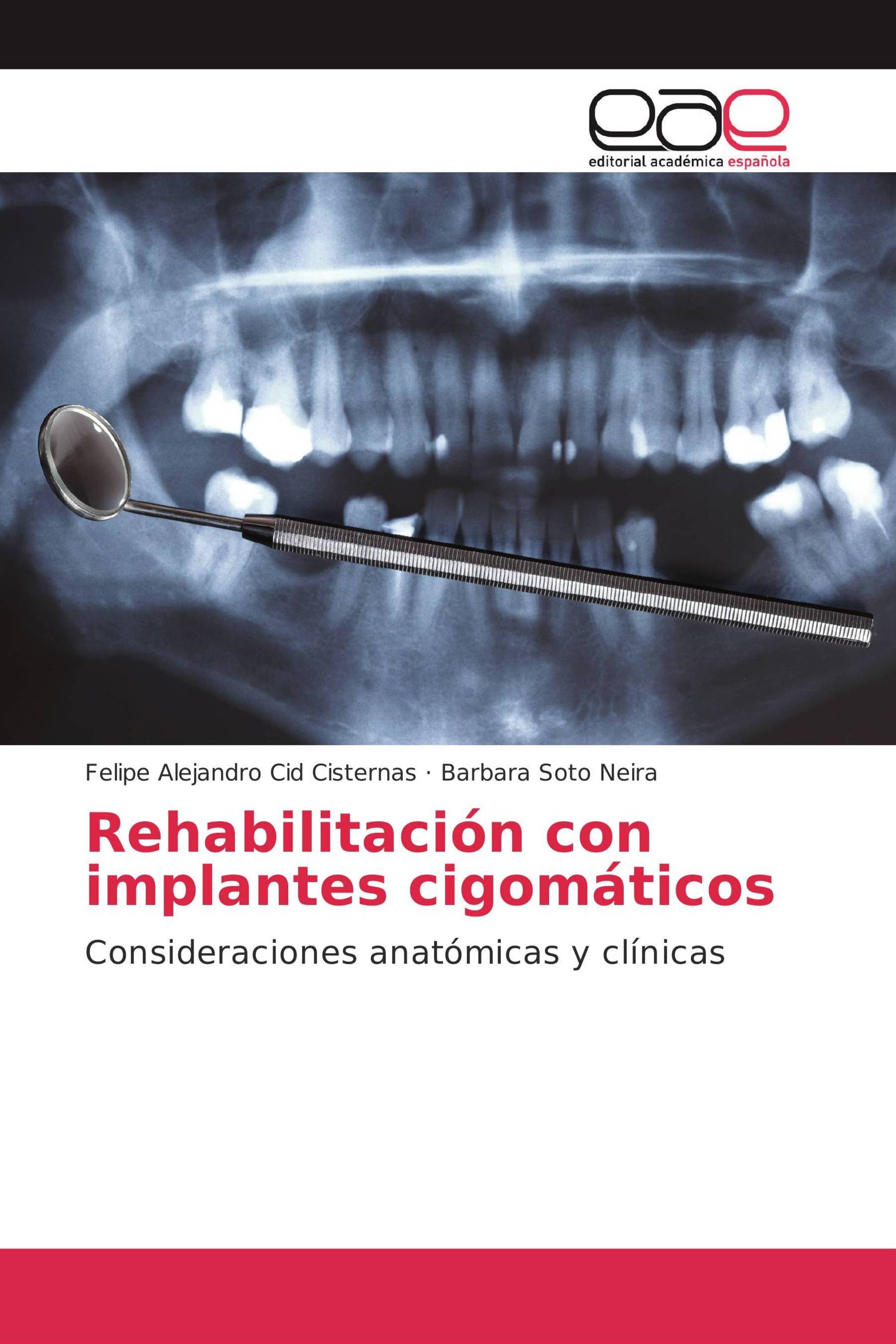 Rehabilitación con implantes cigomáticos