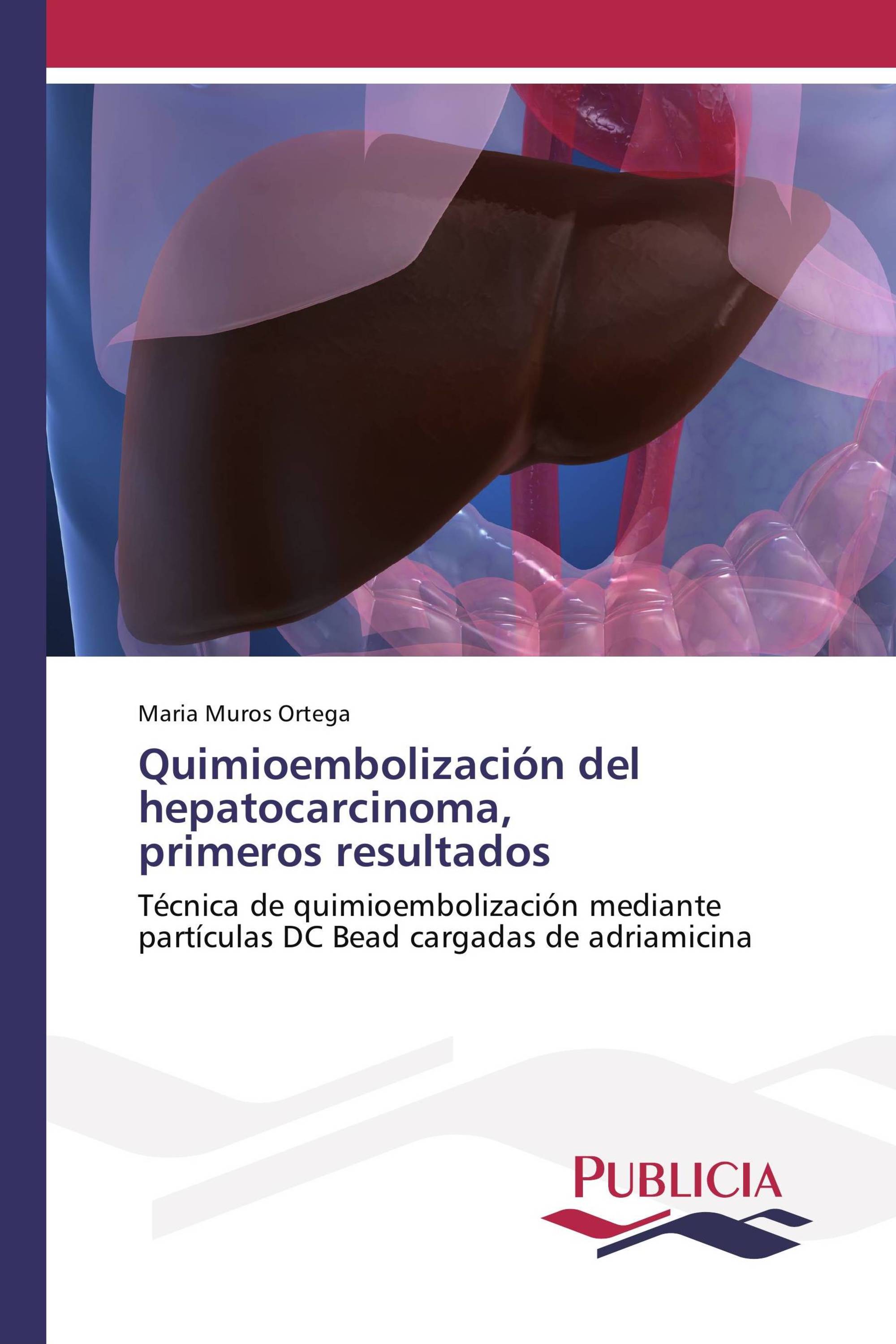 Quimioembolización del hepatocarcinoma, primeros resultados