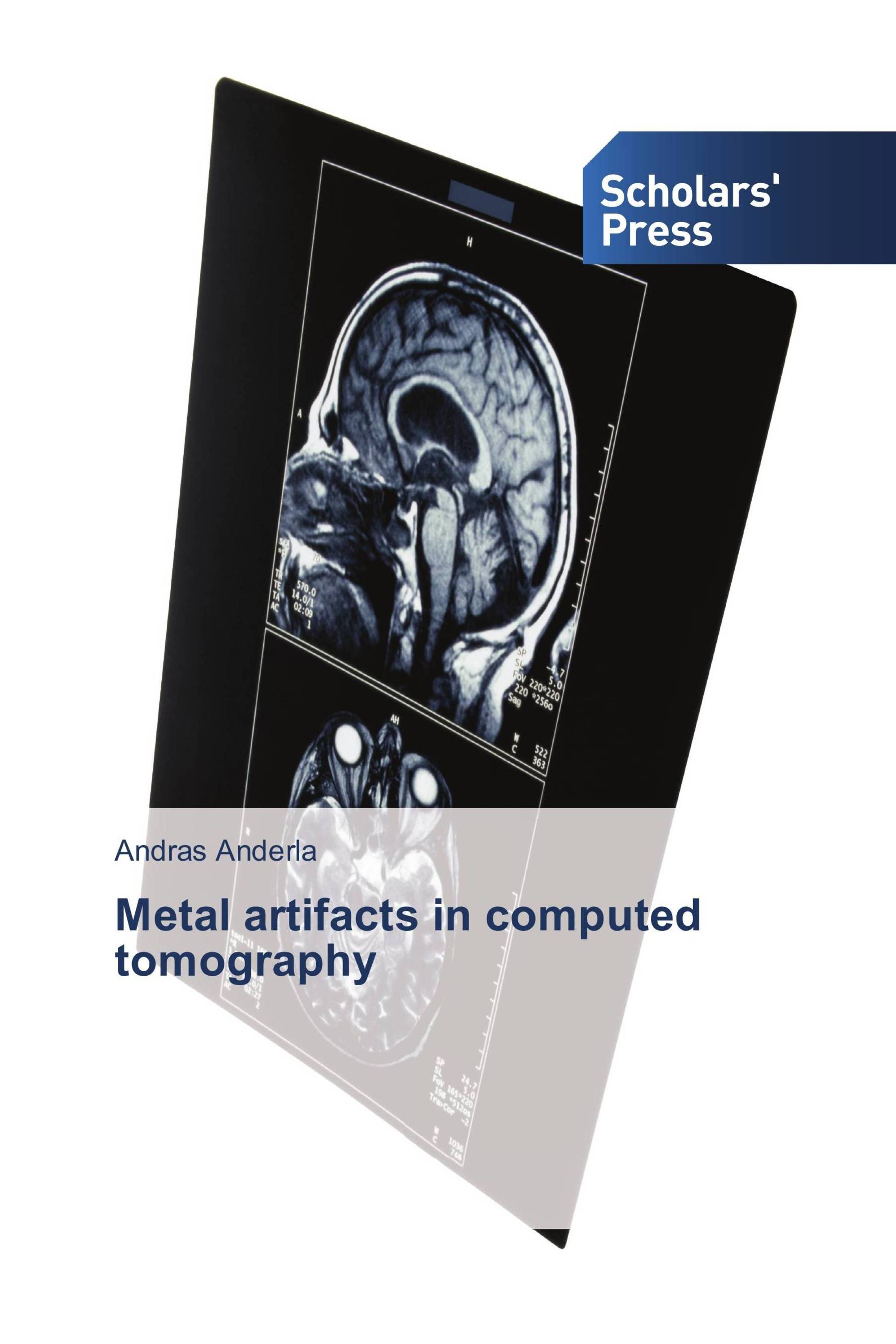 Metal artifacts in computed tomography