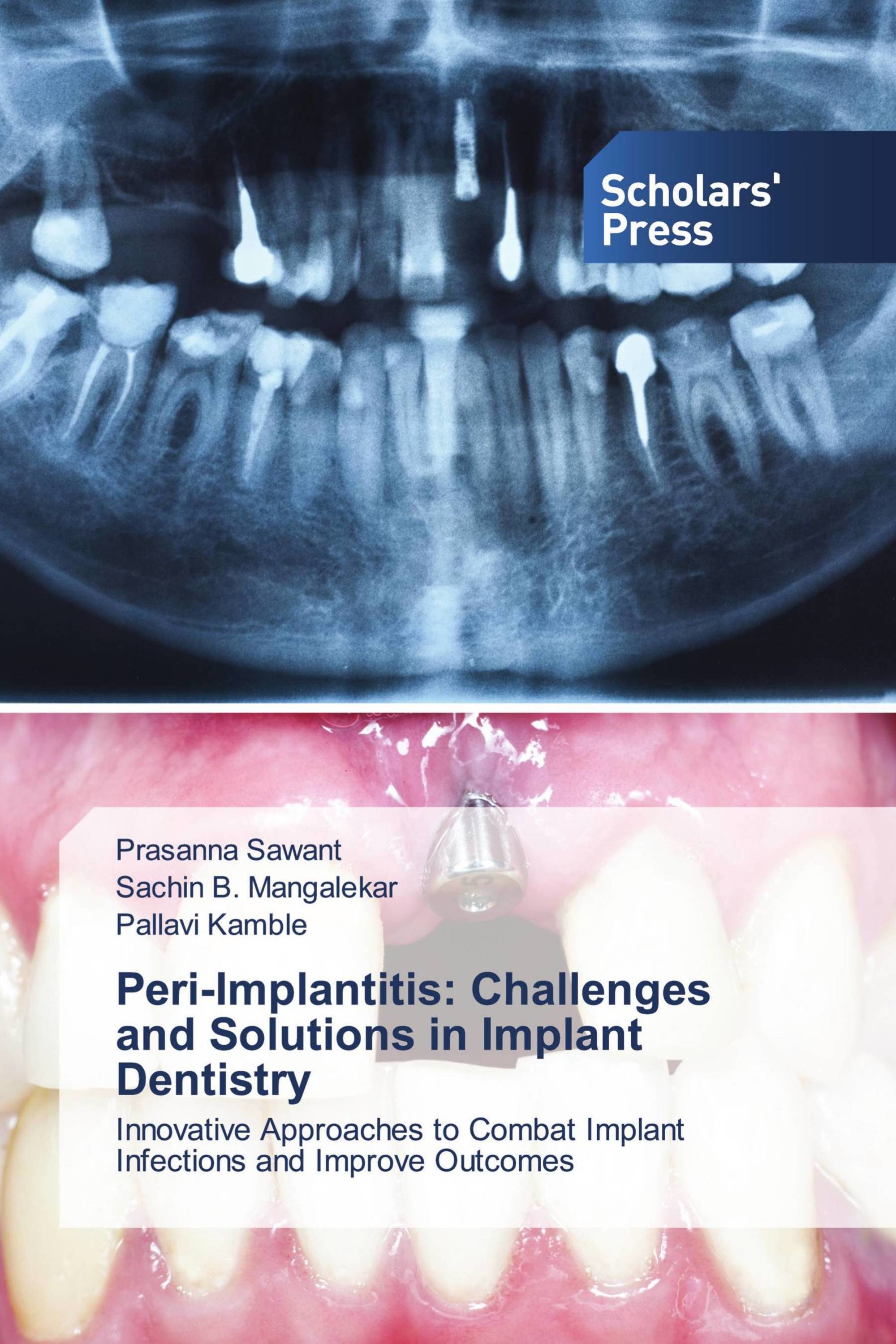 Peri-Implantitis: Challenges and Solutions in Implant Dentistry