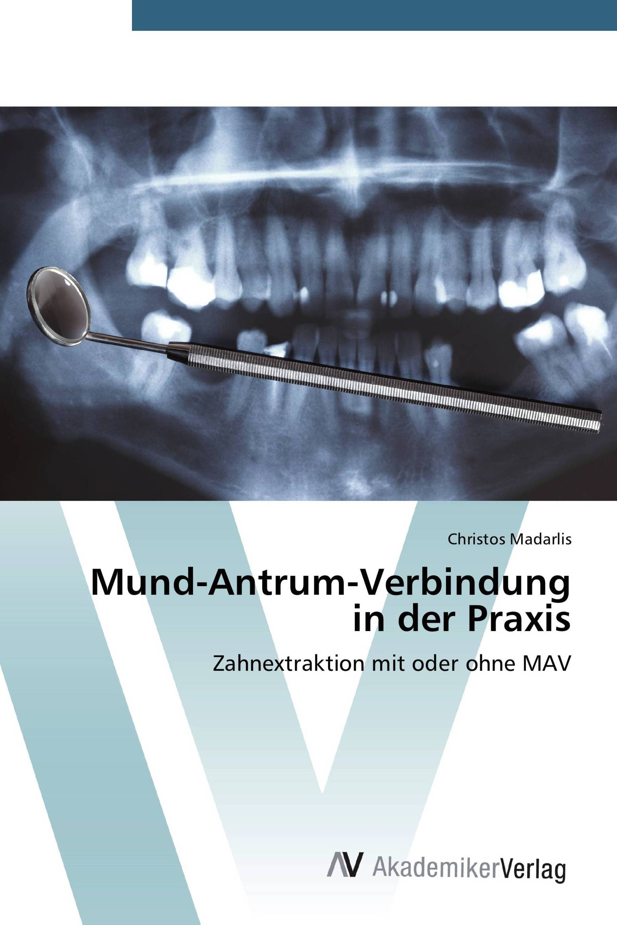 Mund-Antrum-Verbindung in der Praxis