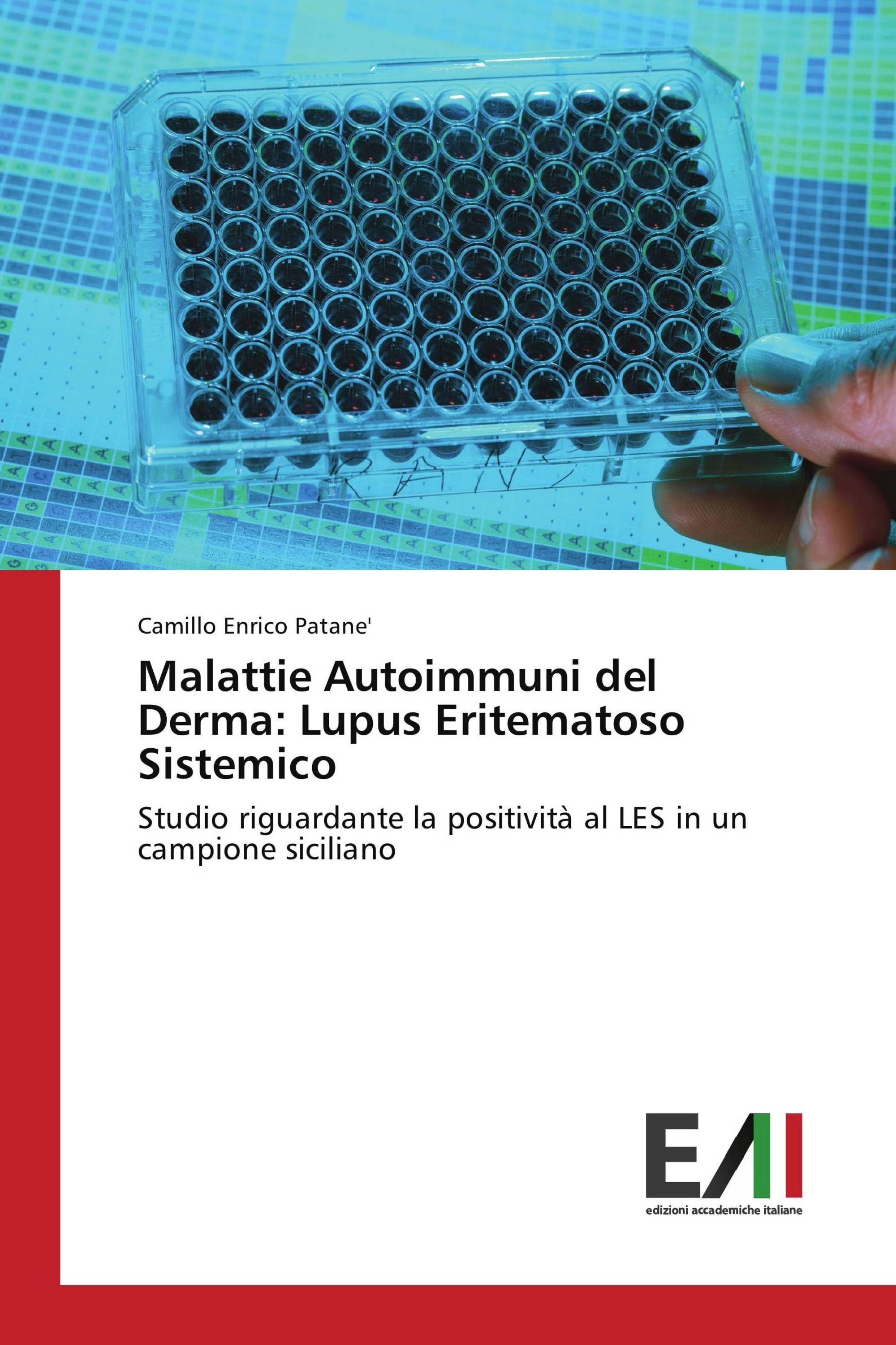 Malattie Autoimmuni del Derma: Lupus Eritematoso Sistemico