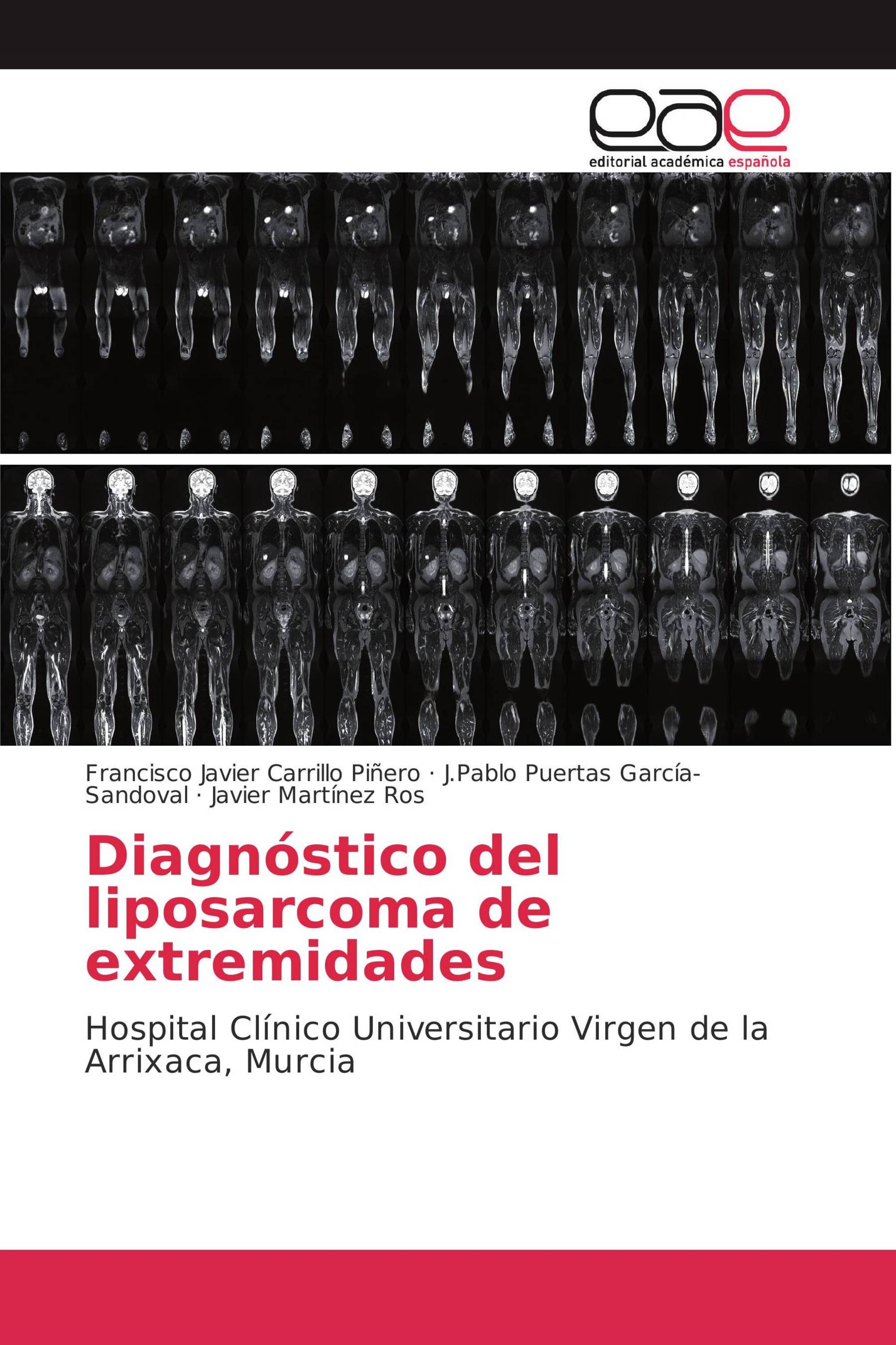 Diagnóstico del liposarcoma de extremidades