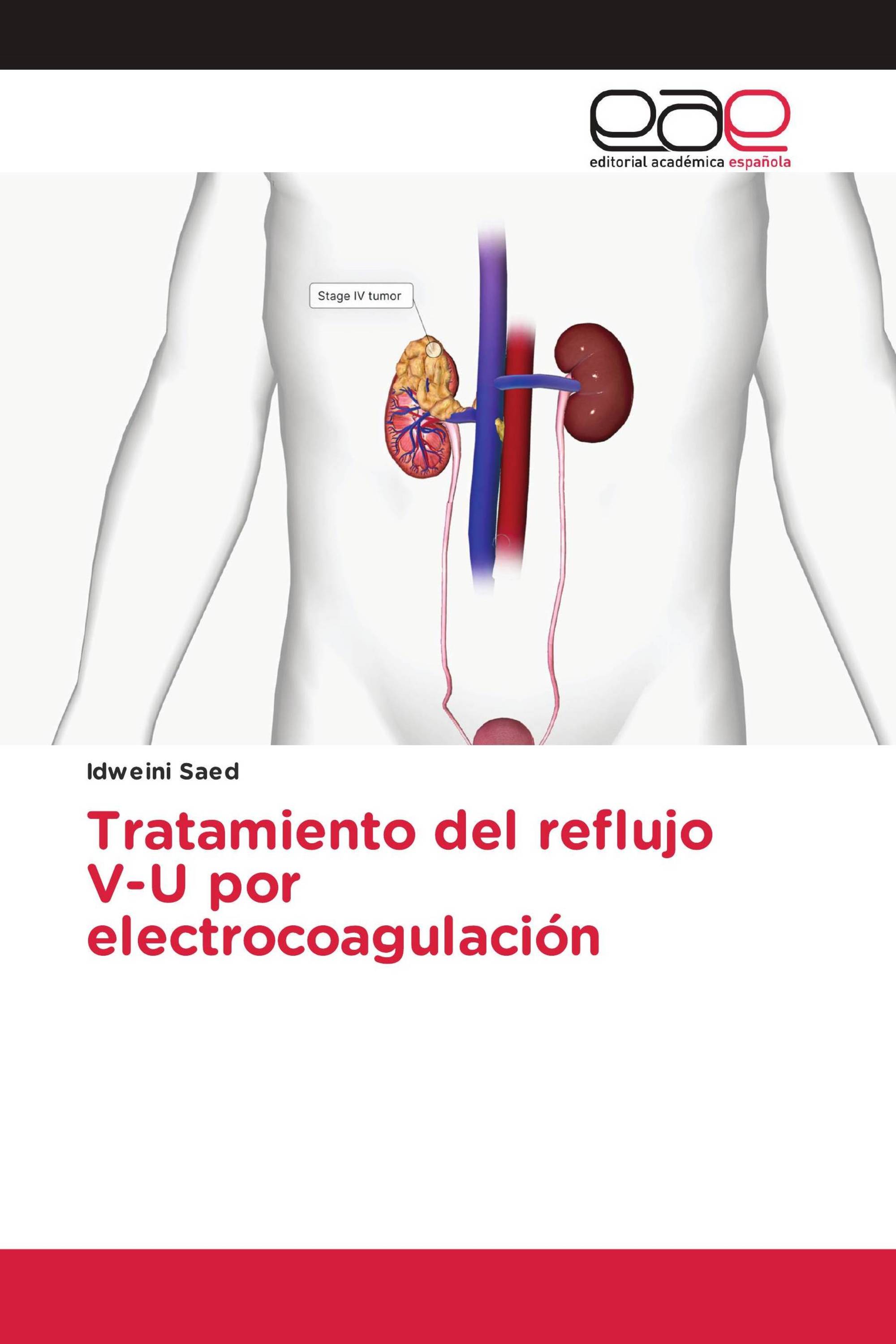 Tratamiento del reflujo V-U por electrocoagulación