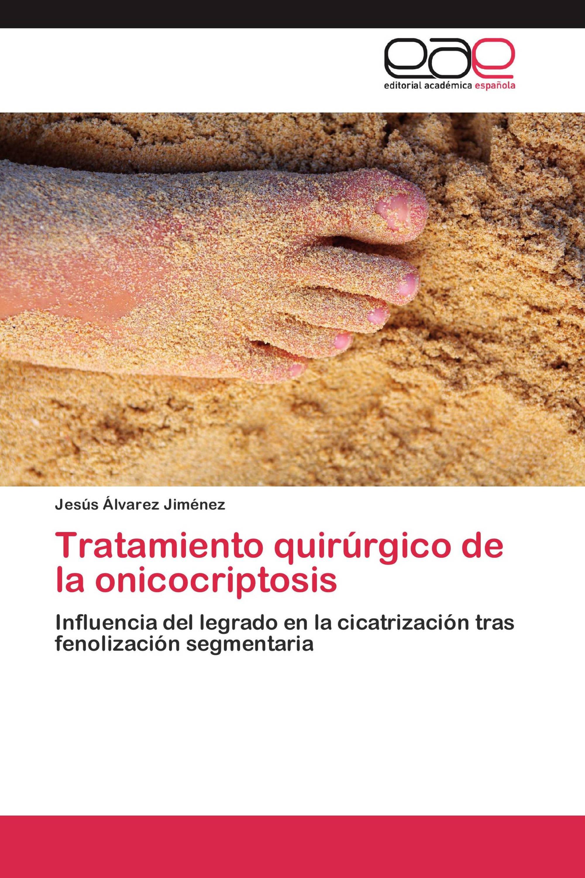 Tratamiento quirúrgico de la onicocriptosis