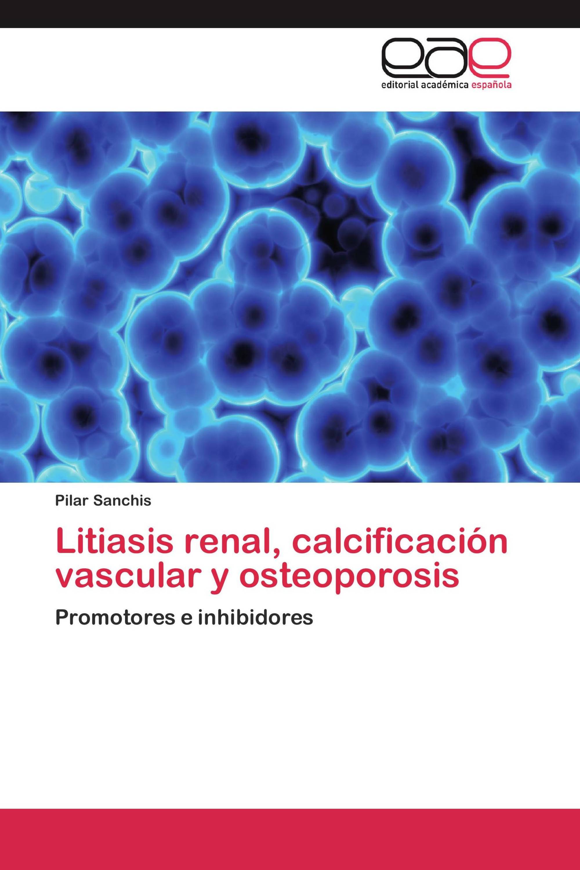 Litiasis renal, calcificación vascular y osteoporosis