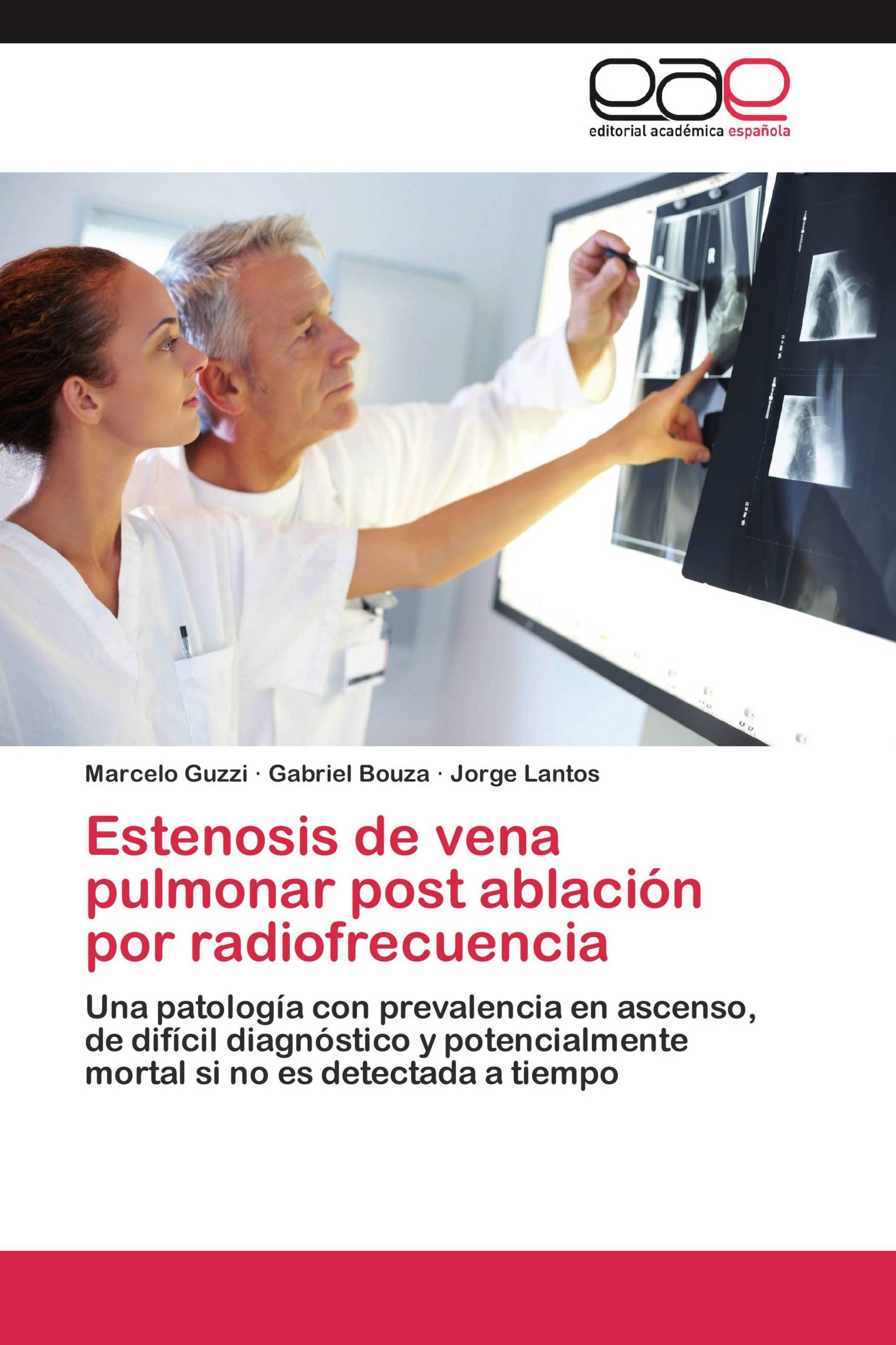 Estenosis de vena pulmonar post ablación por radiofrecuencia