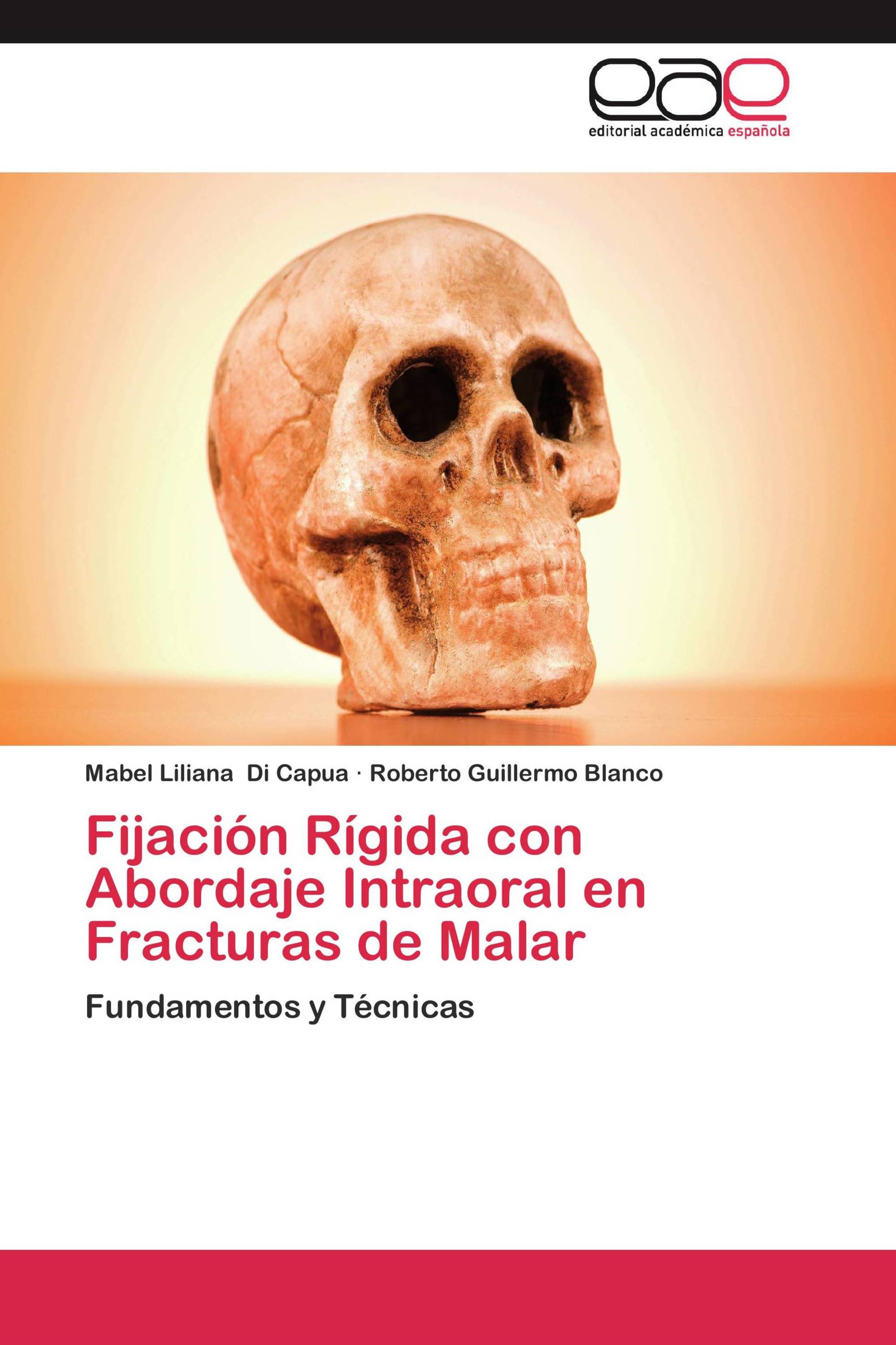 Fijación Rígida con Abordaje Intraoral en Fracturas de Malar