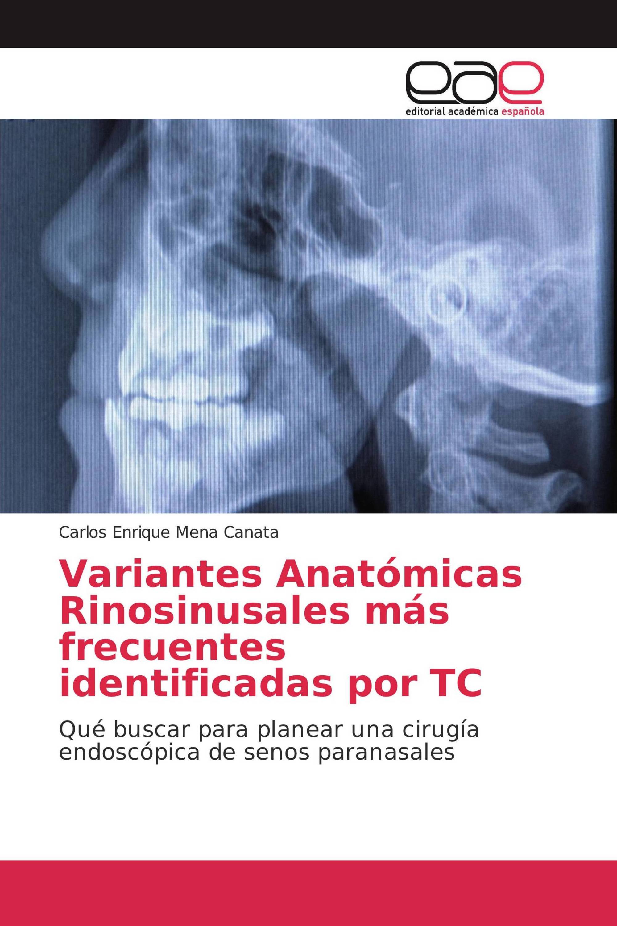 Variantes Anatómicas Rinosinusales más frecuentes identificadas por TC