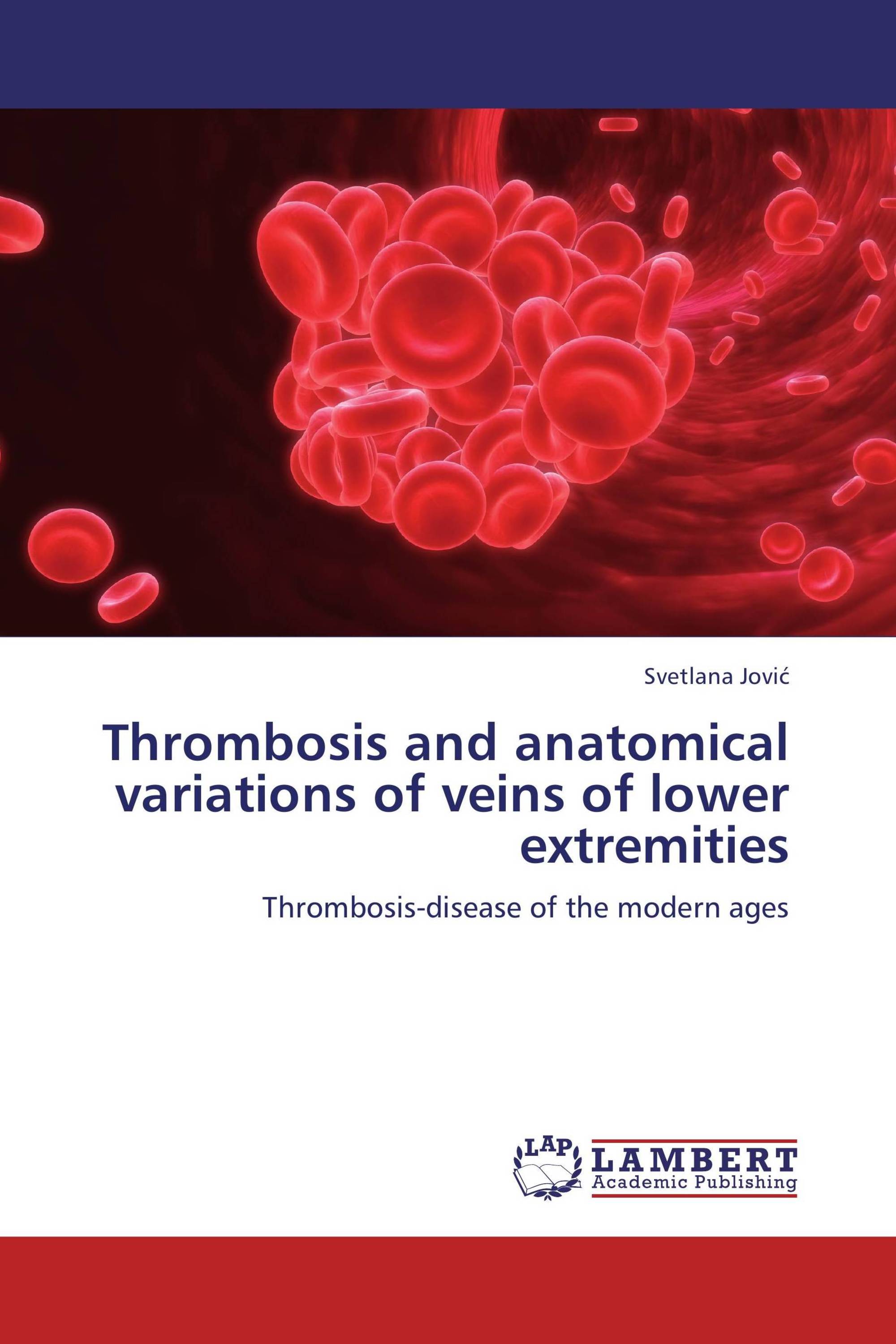 Thrombosis and anatomical variations of veins of lower extremities