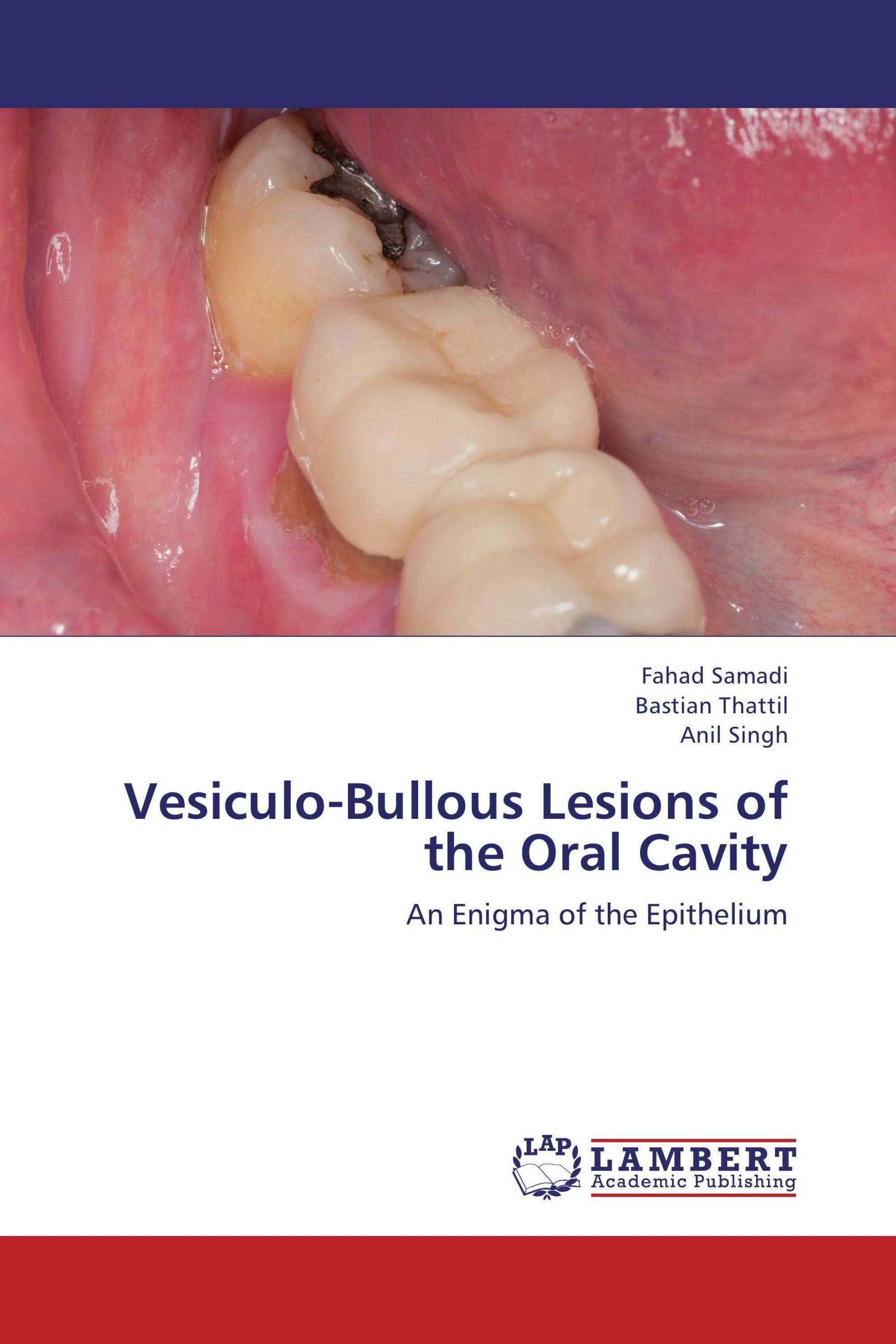 Vesiculo-Bullous Lesions of the Oral Cavity