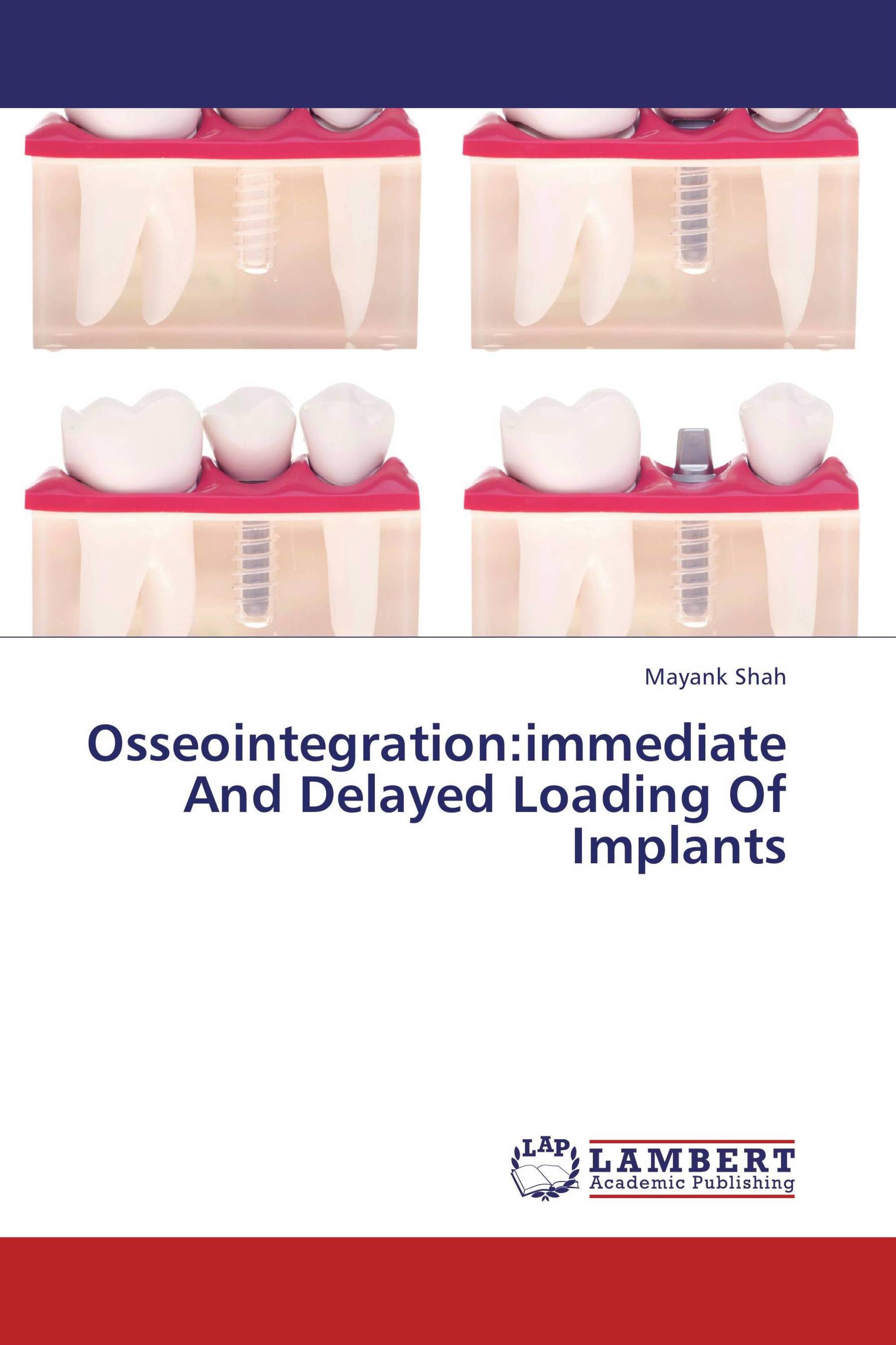 Osseointegration:immediate And Delayed Loading Of Implants