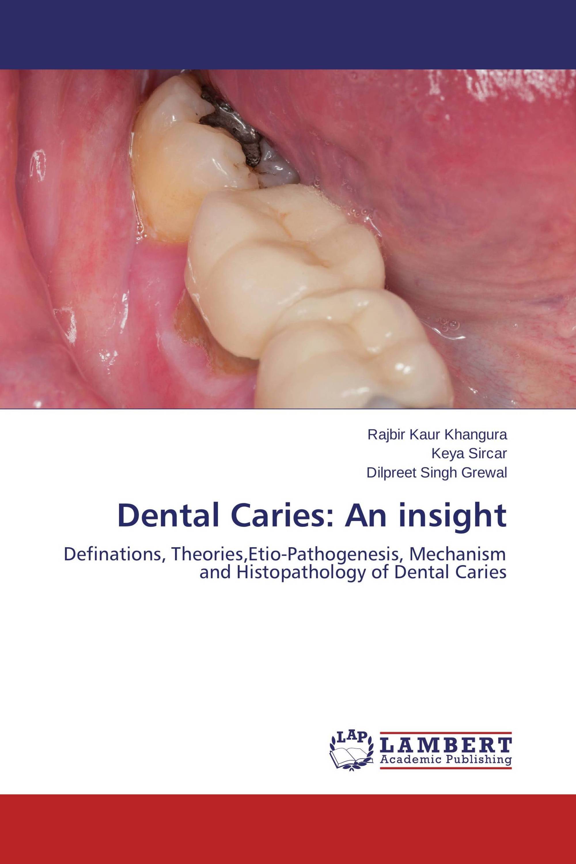 Dental Caries: An insight