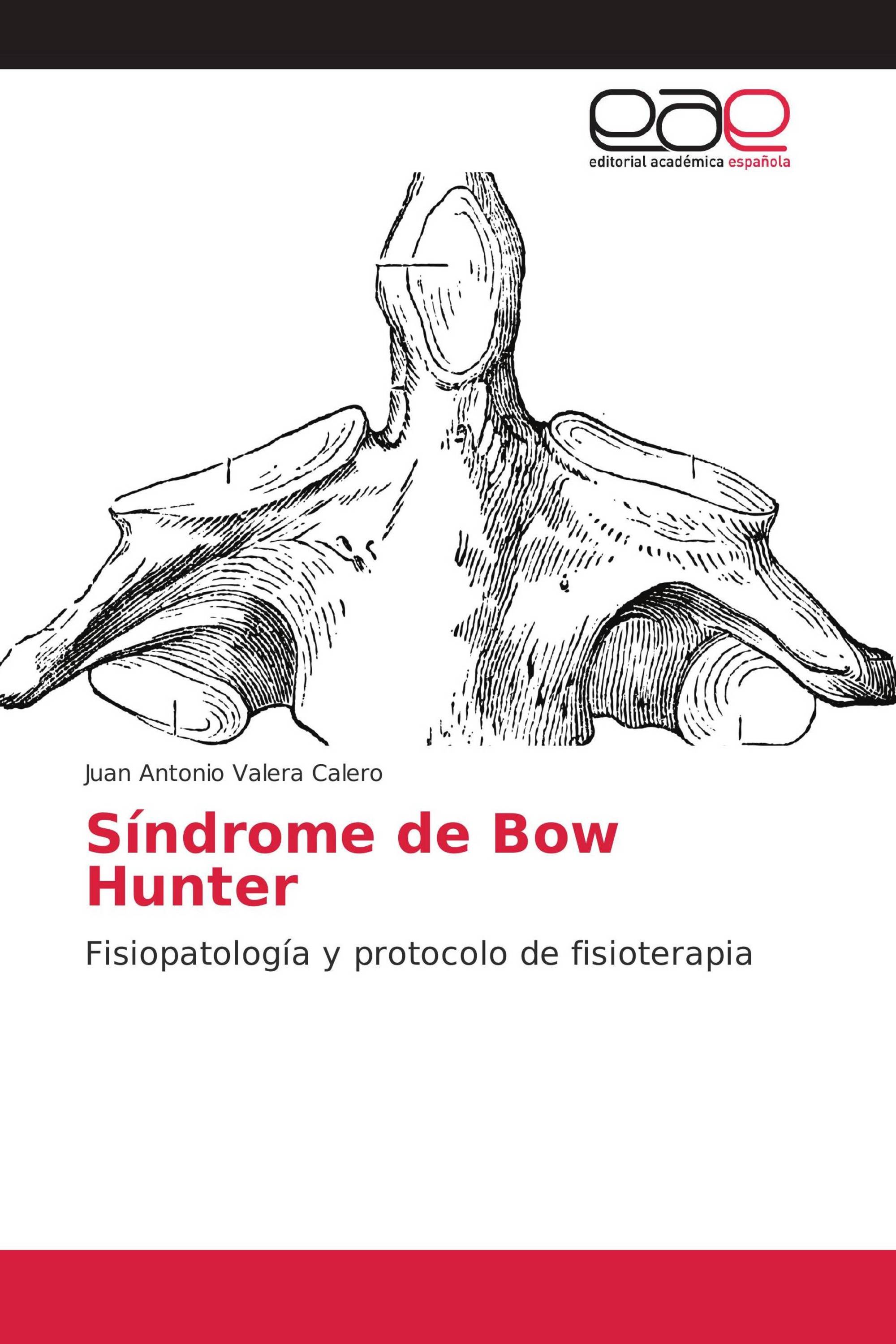 Síndrome de Bow Hunter