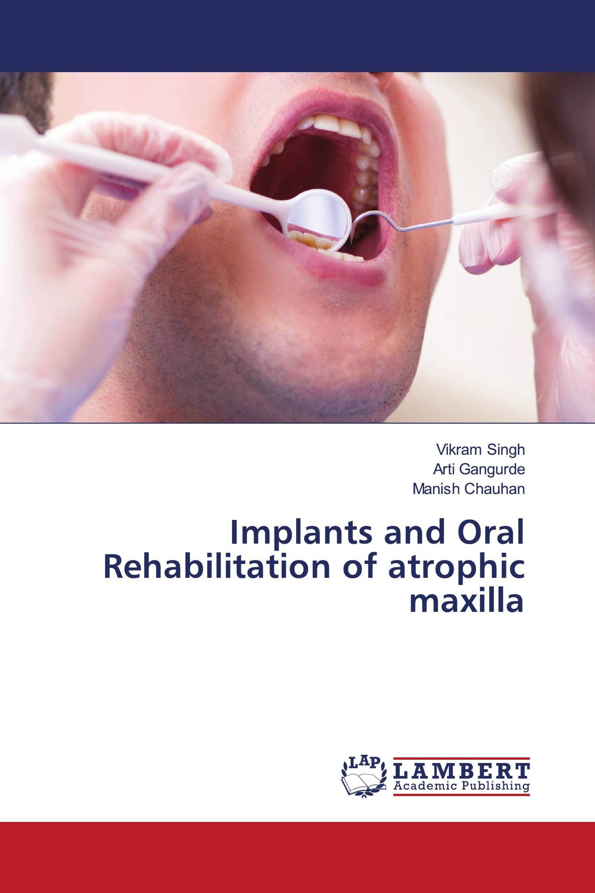 Implants and Oral Rehabilitation of atrophic maxilla