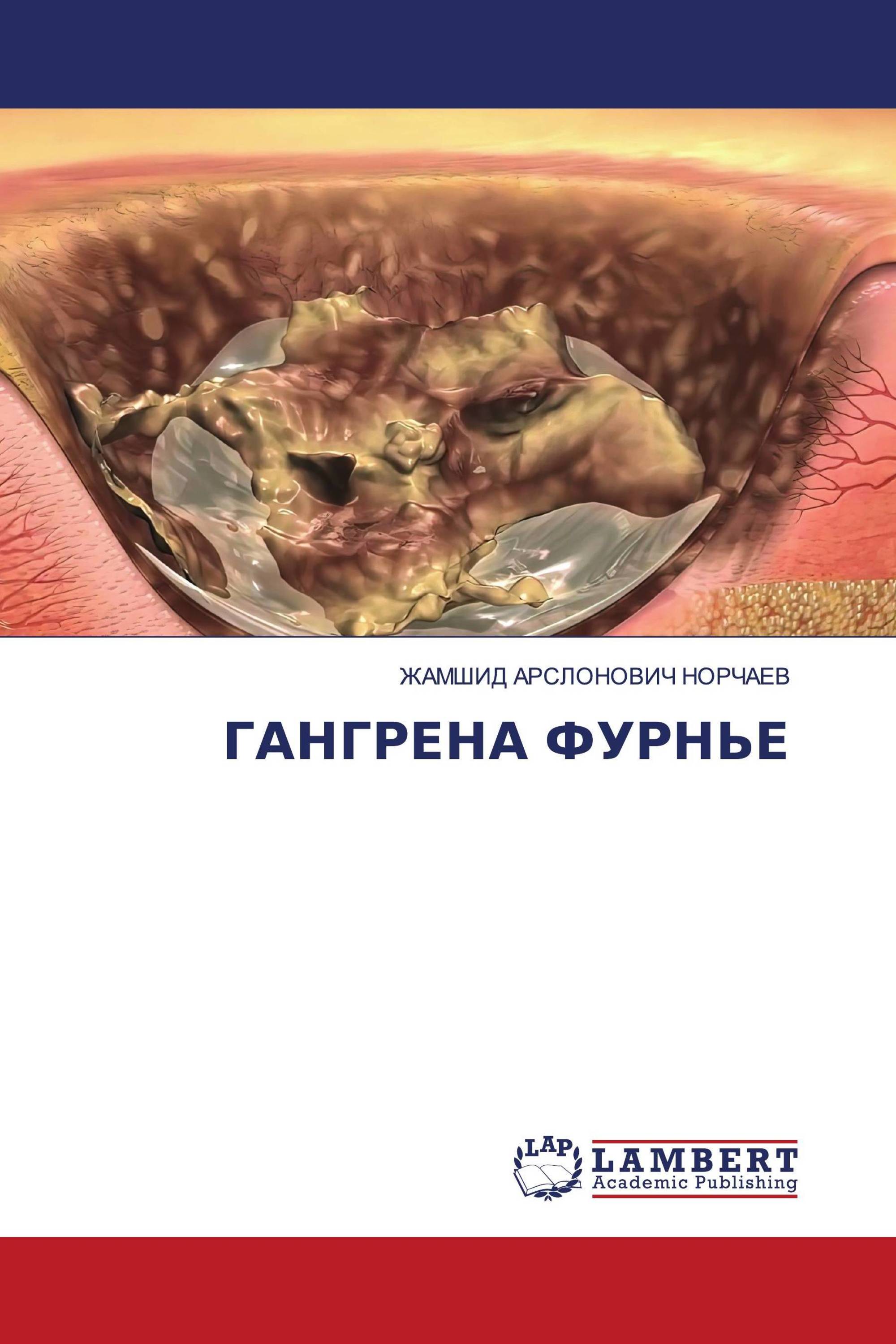 ГАНГРЕНА ФУРНЬЕ