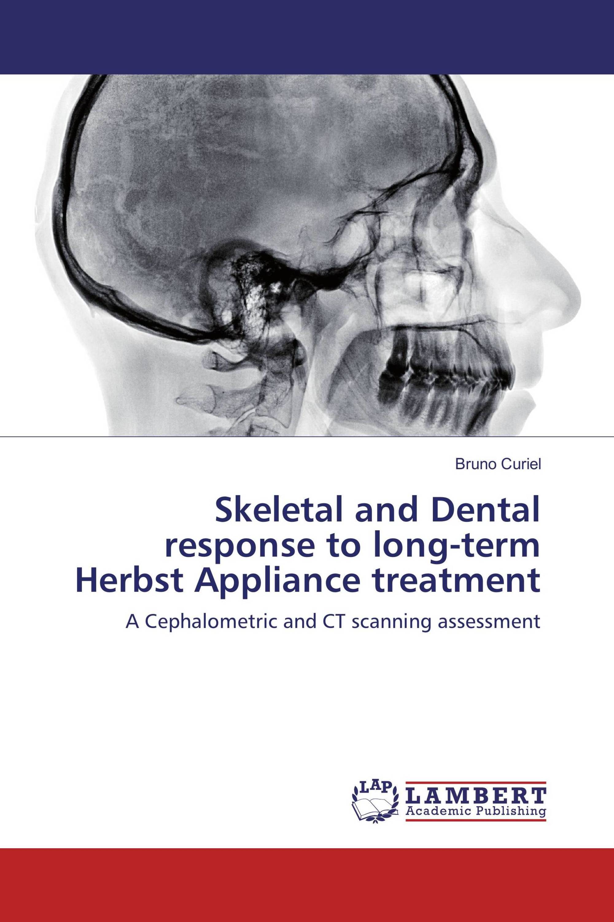 Skeletal and Dental response to longterm Herbst Appliance treatment