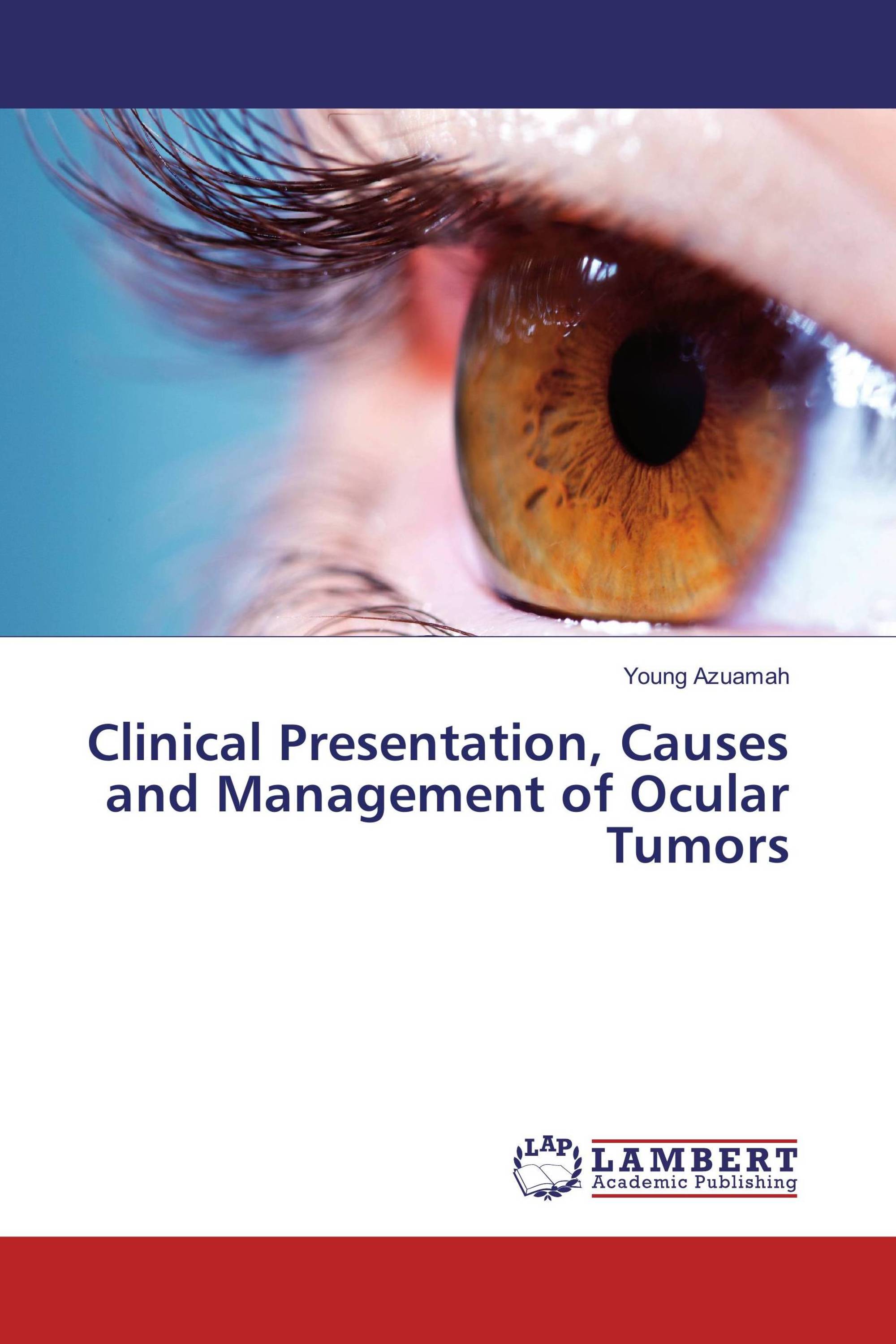 Clinical Presentation, Causes and Management of Ocular Tumors