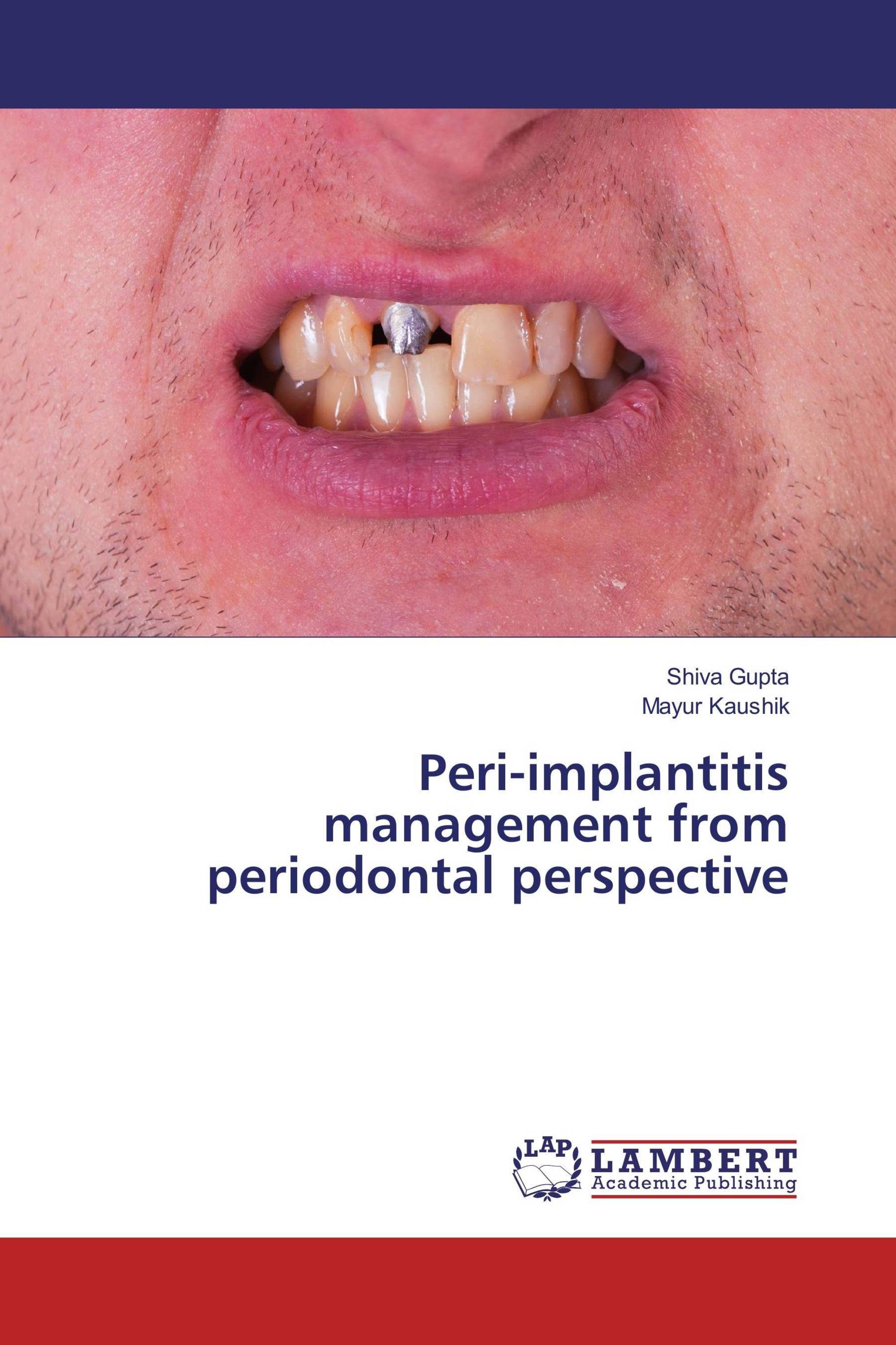 Peri-implantitis Management From Periodontal Perspective / 978-3-659 ...