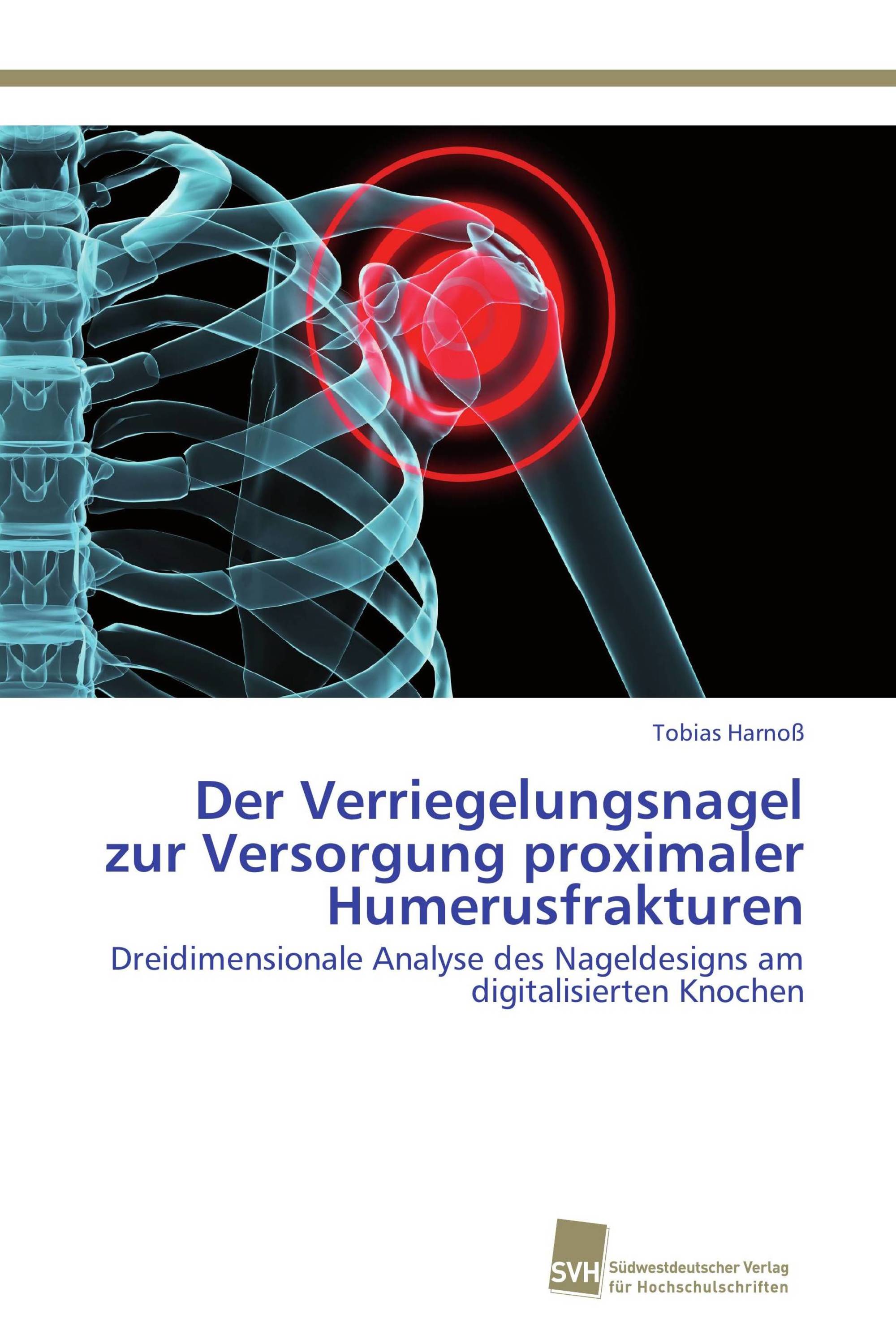 Der Verriegelungsnagel zur Versorgung proximaler Humerusfrakturen