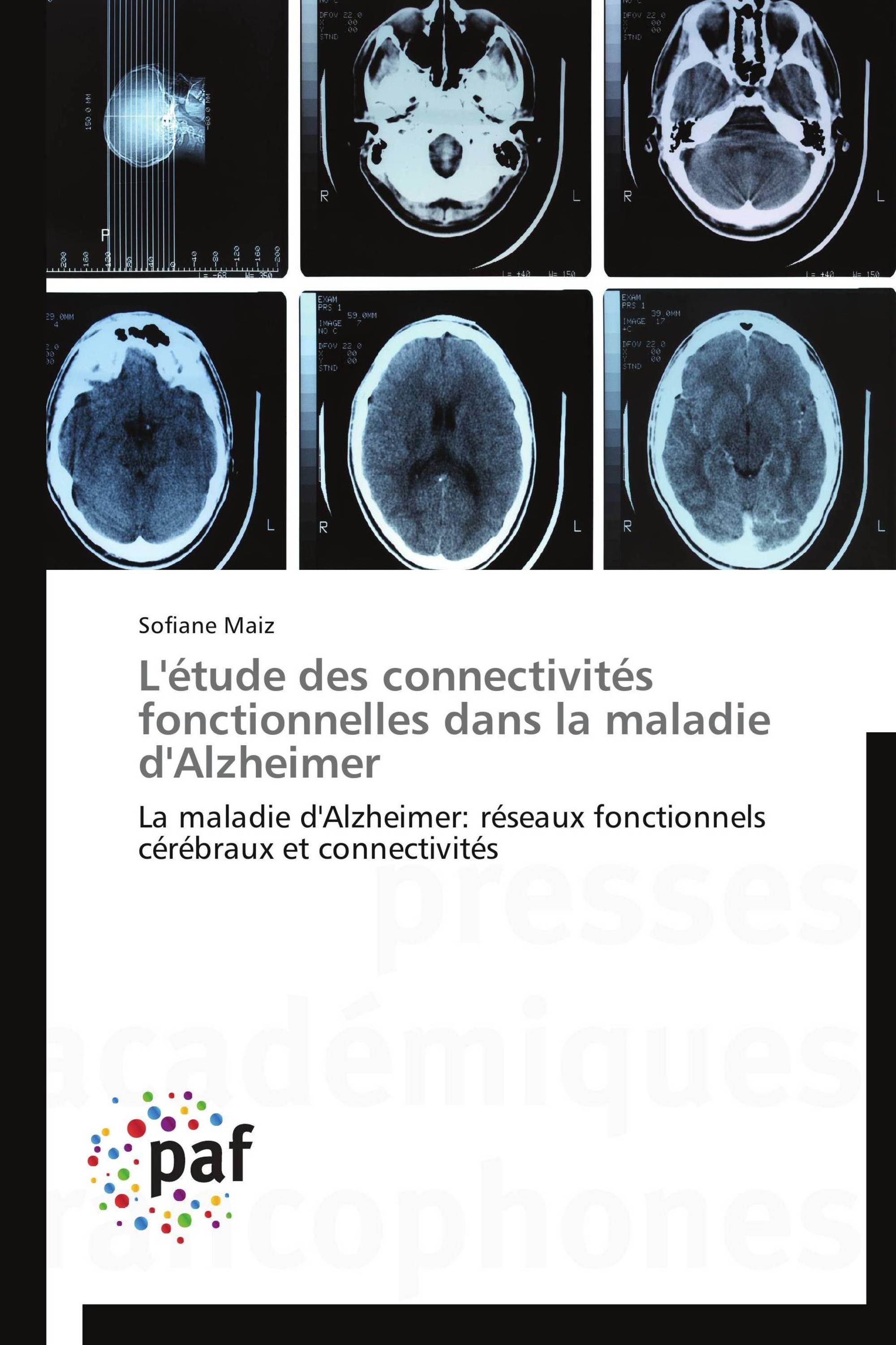 L'étude des connectivités fonctionnelles dans la maladie d'Alzheimer