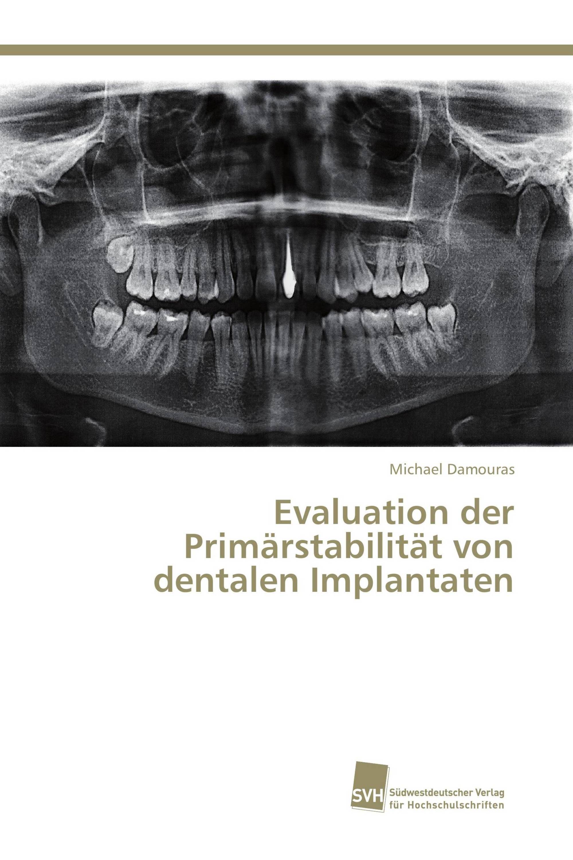 Evaluation der Primärstabilität von dentalen Implantaten