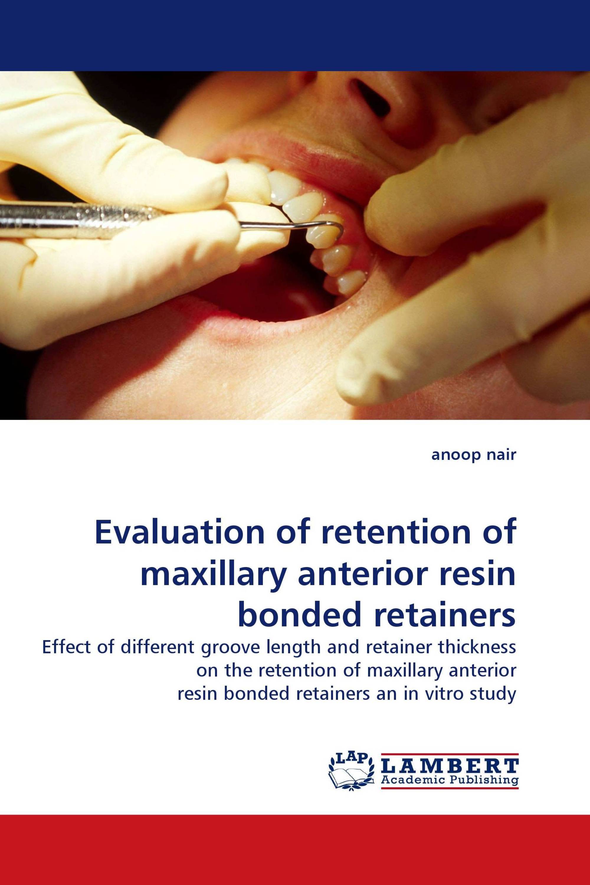 Evaluation of retention of maxillary anterior resin bonded retainers