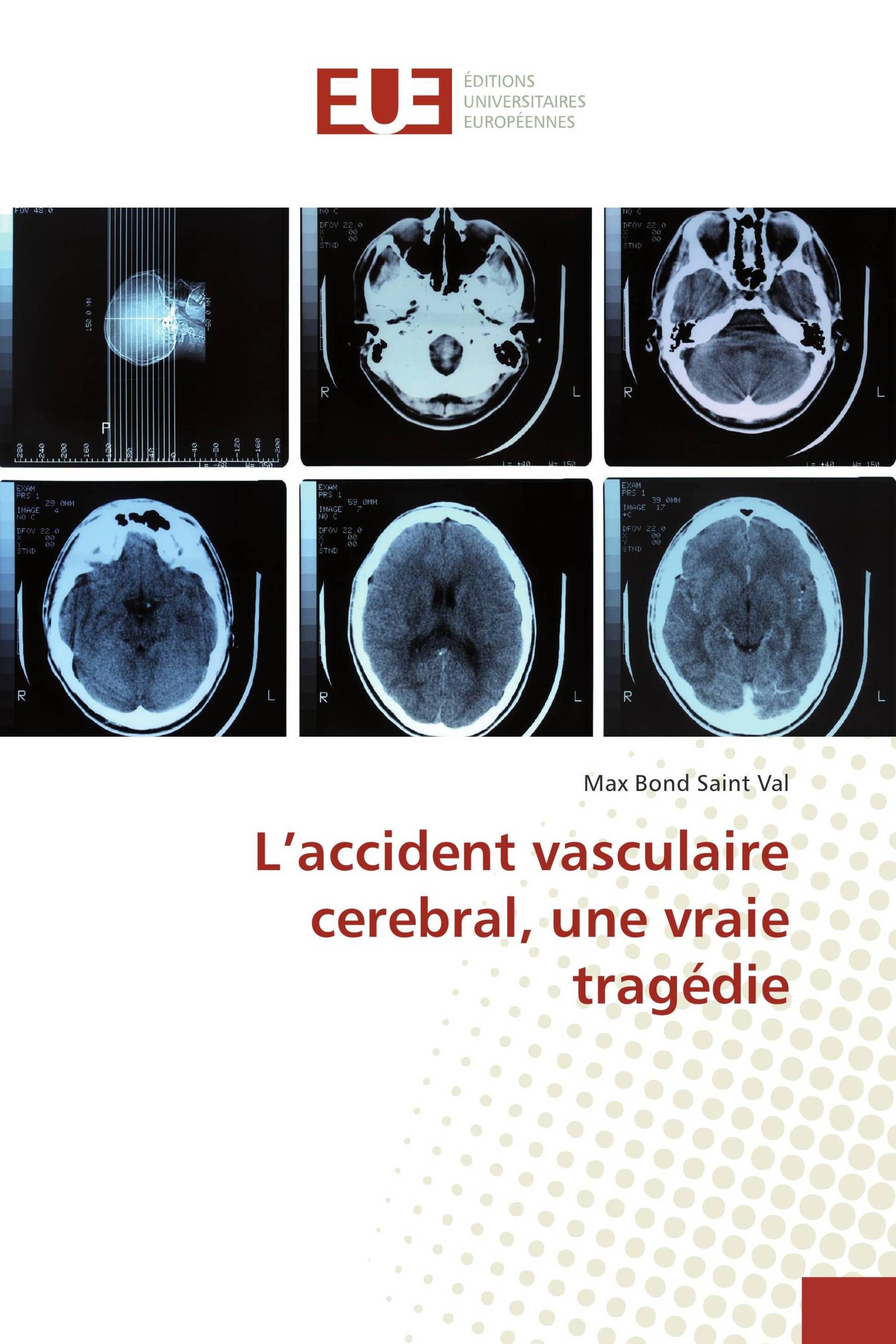 L’accident vasculaire cerebral, une vraie tragédie