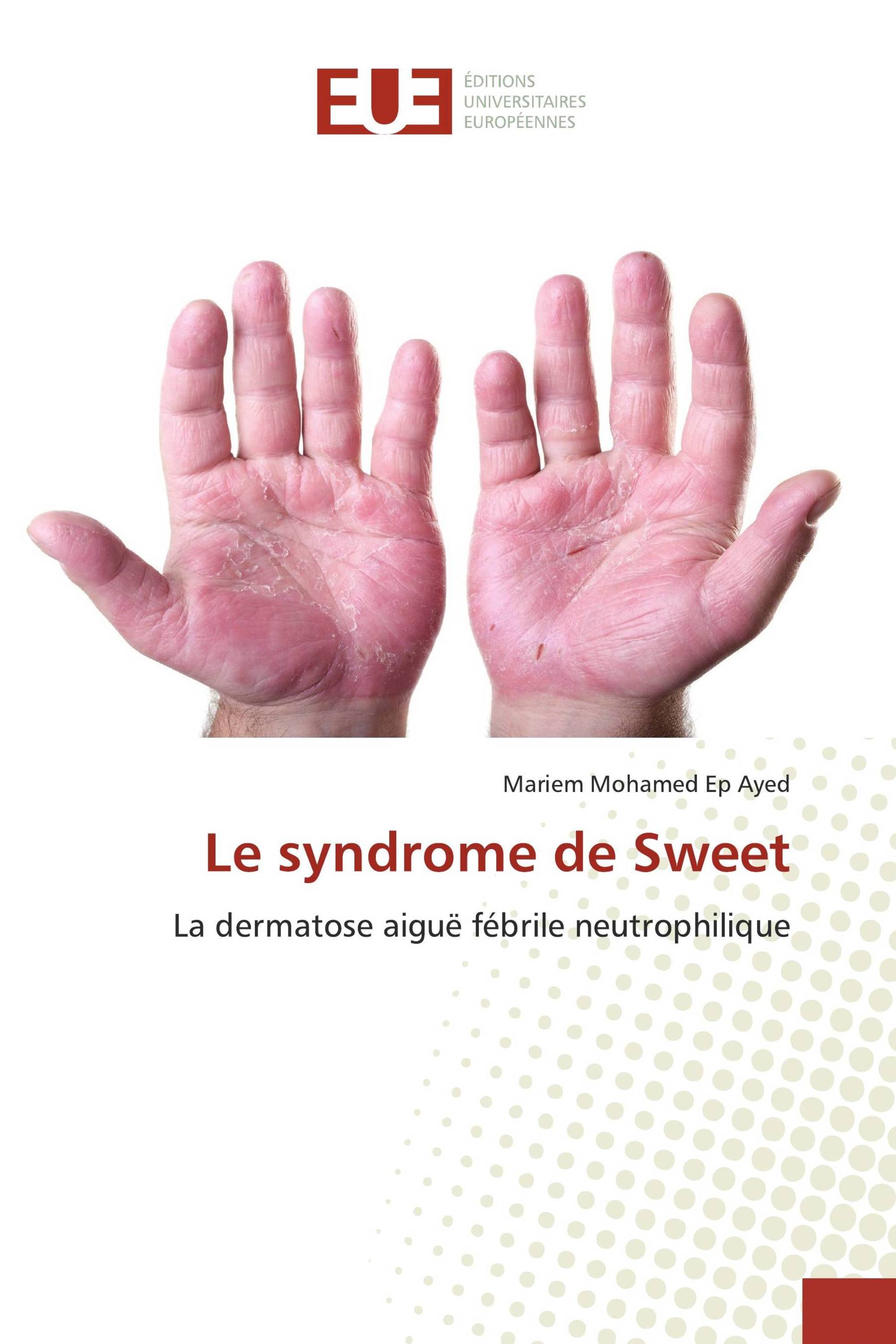 Le syndrome de Sweet