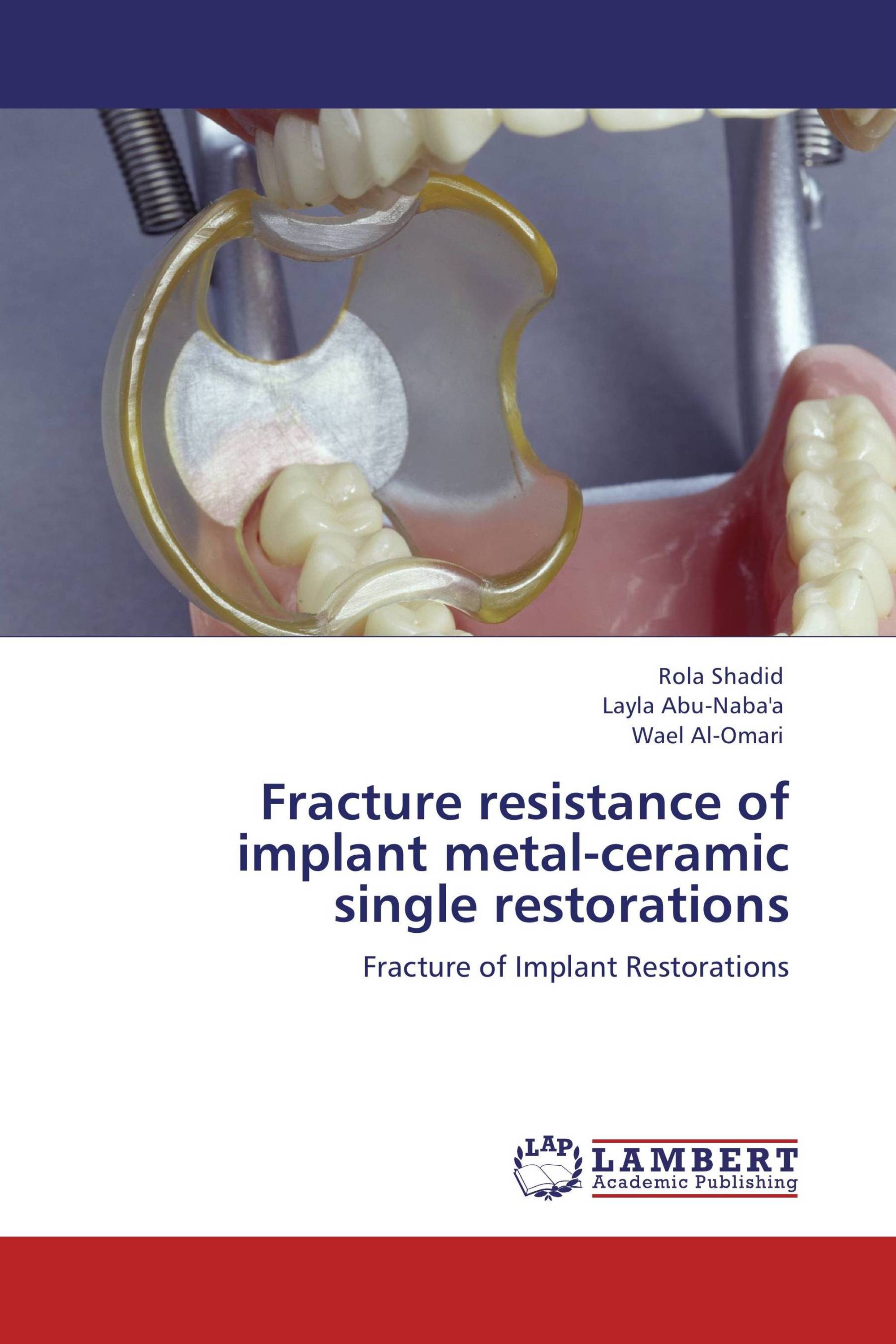 Fracture resistance of implant metal-ceramic single restorations