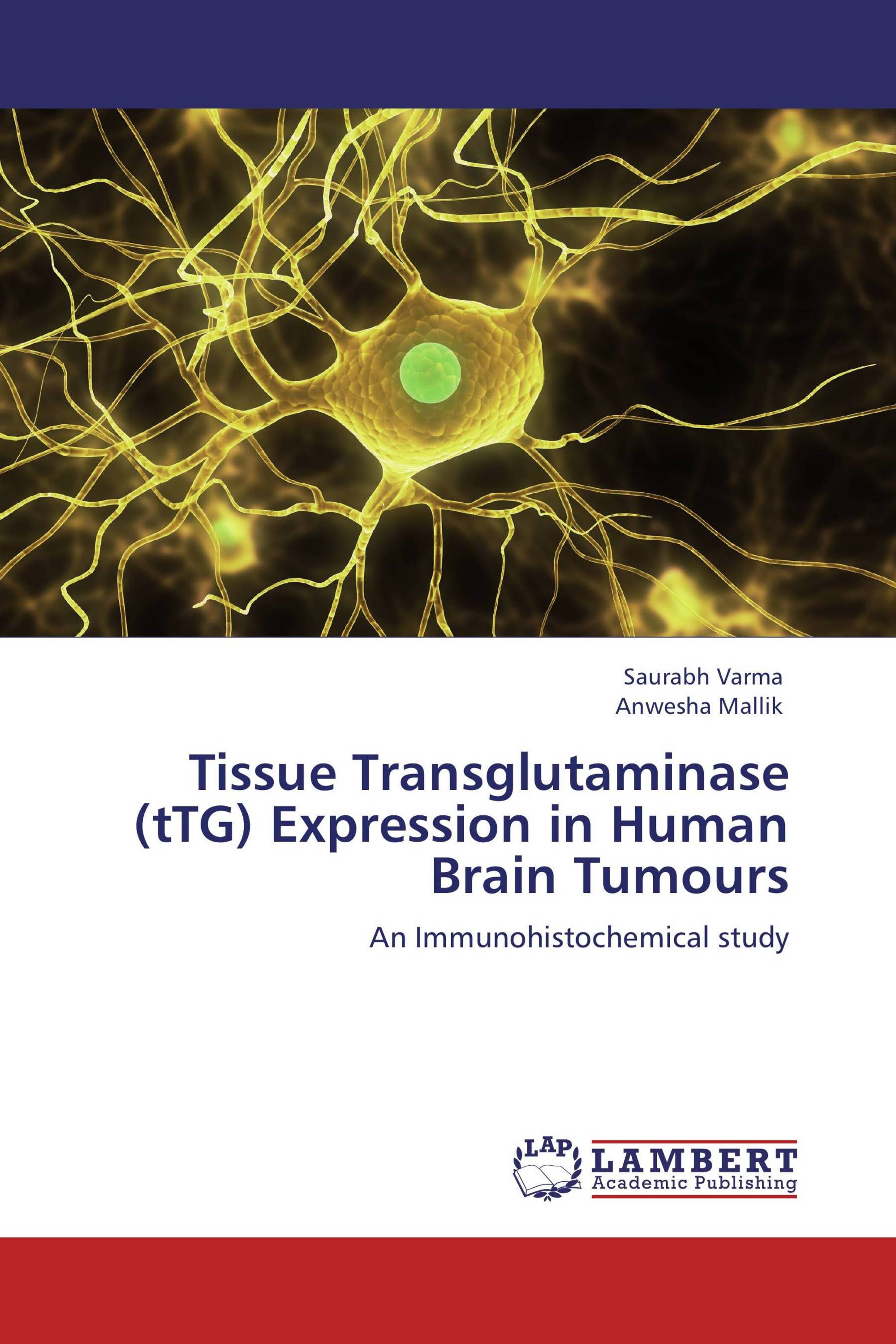 Tissue Transglutaminase (tTG) Expression in Human Brain Tumours