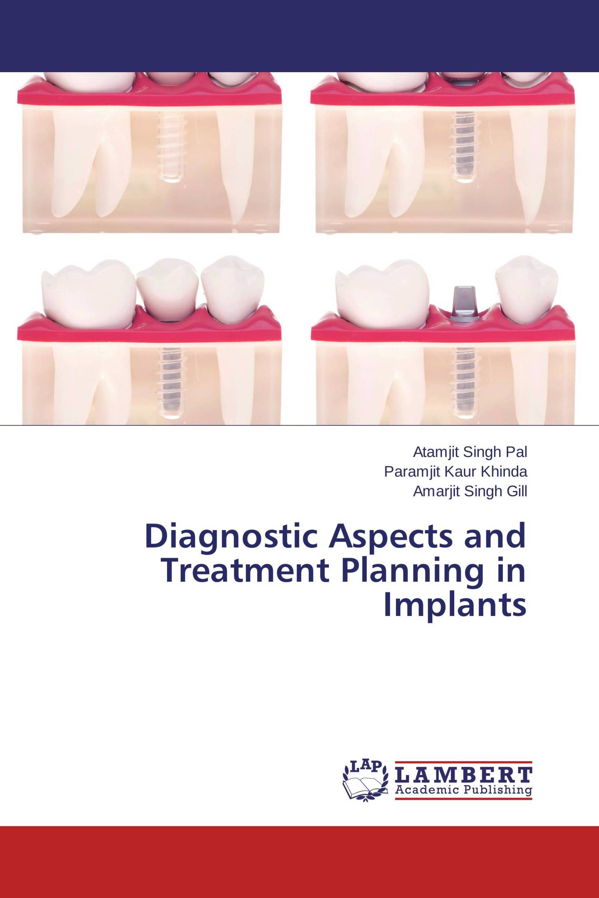 Diagnostic Aspects and Treatment Planning in Implants