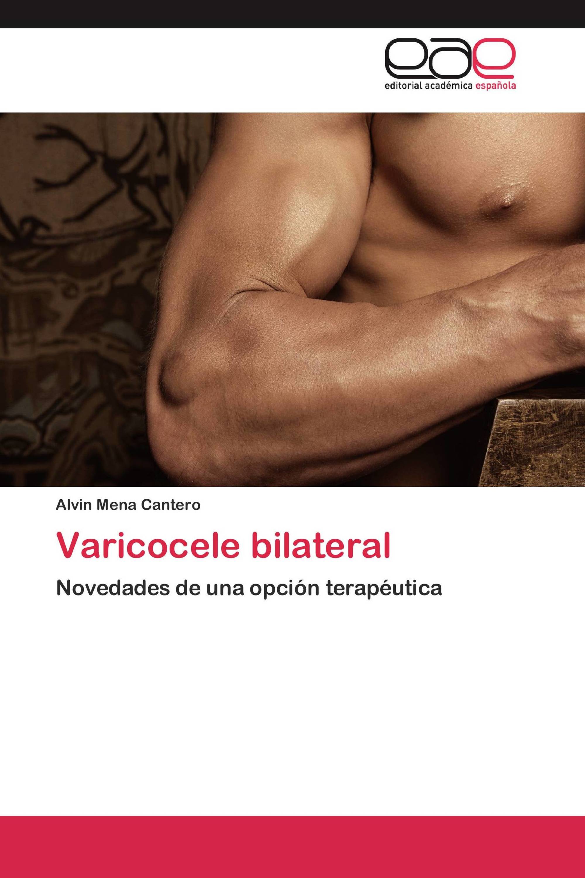 Varicocele bilateral