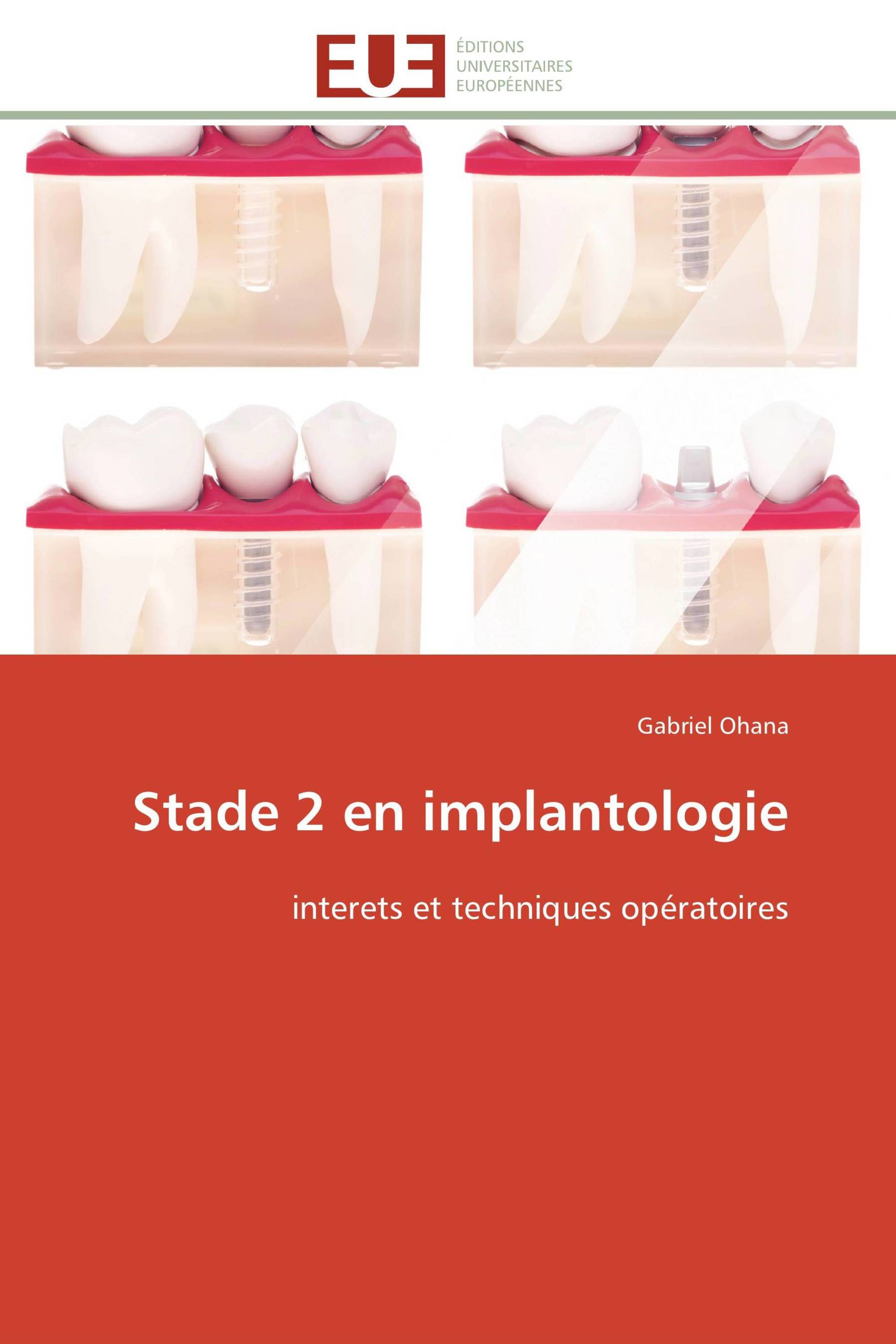 Stade 2 en implantologie