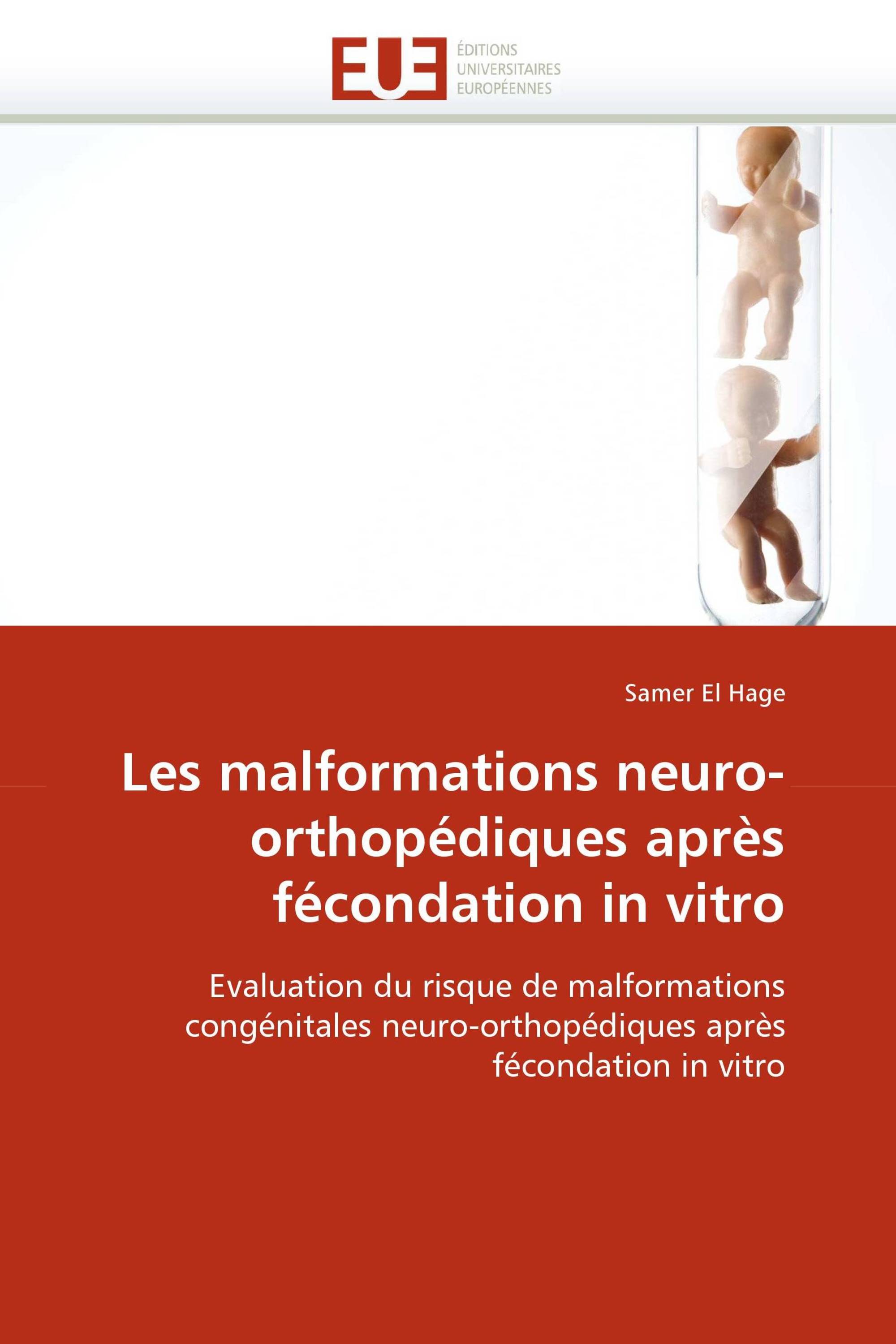 Les malformations neuro-orthopédiques après fécondation in vitro