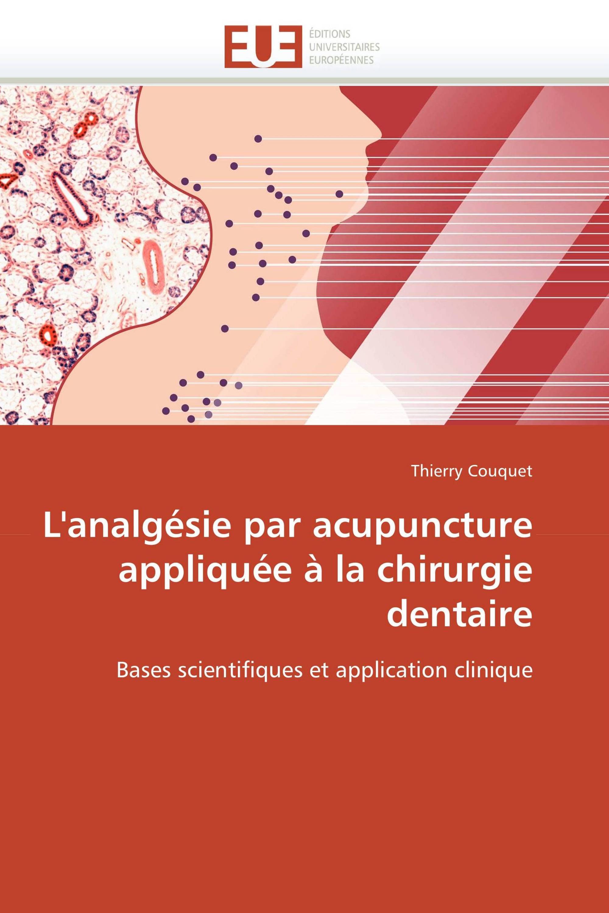 L'analgésie par acupuncture appliquée à la chirurgie dentaire