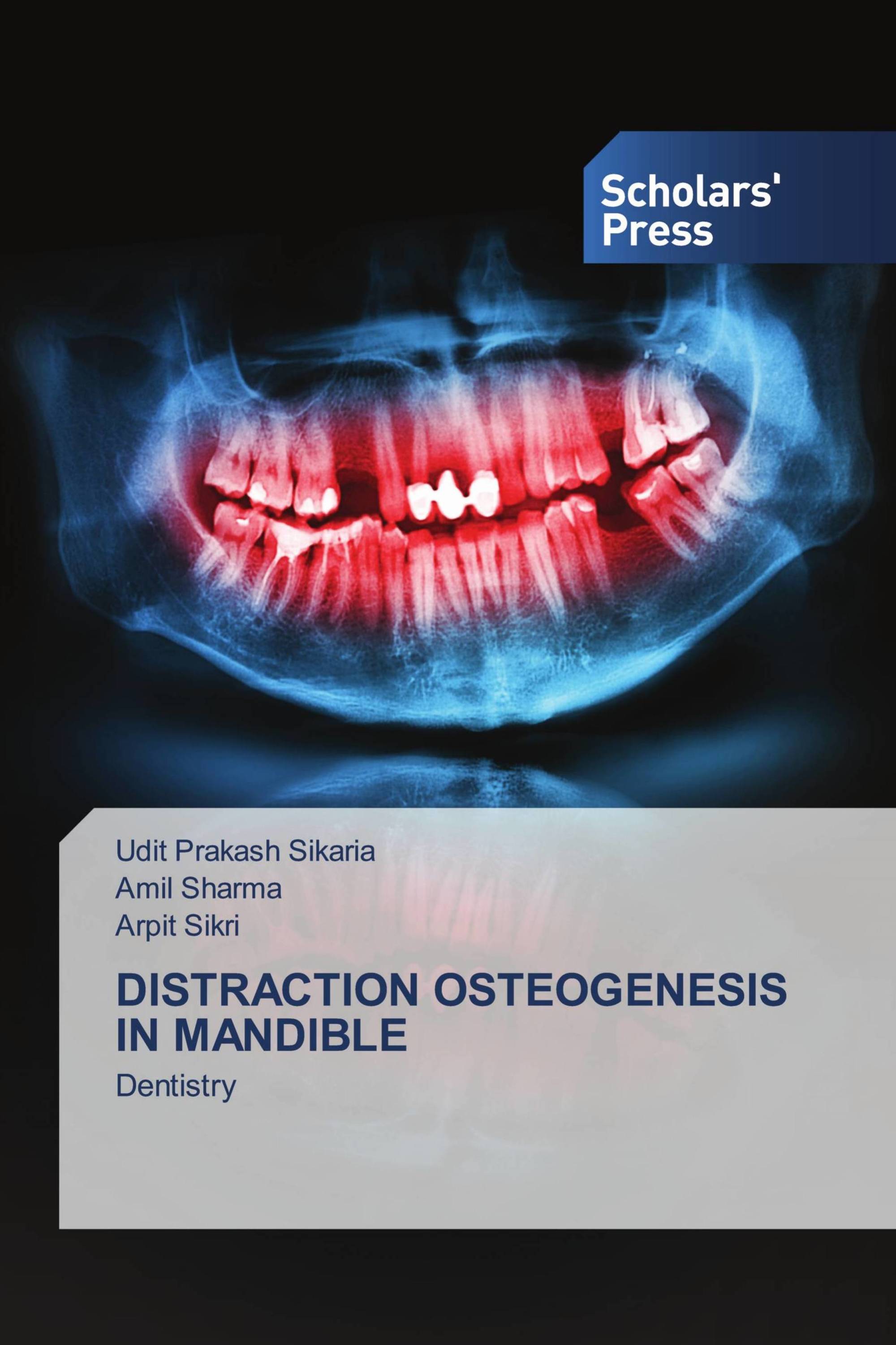 DISTRACTION OSTEOGENESIS IN MANDIBLE