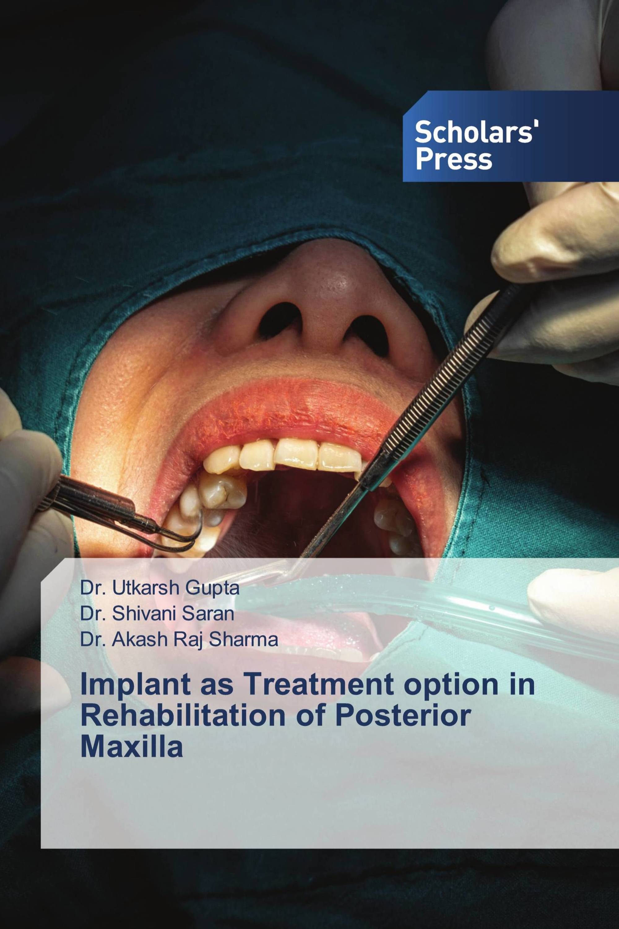 Implant as Treatment option in Rehabilitation of Posterior Maxilla