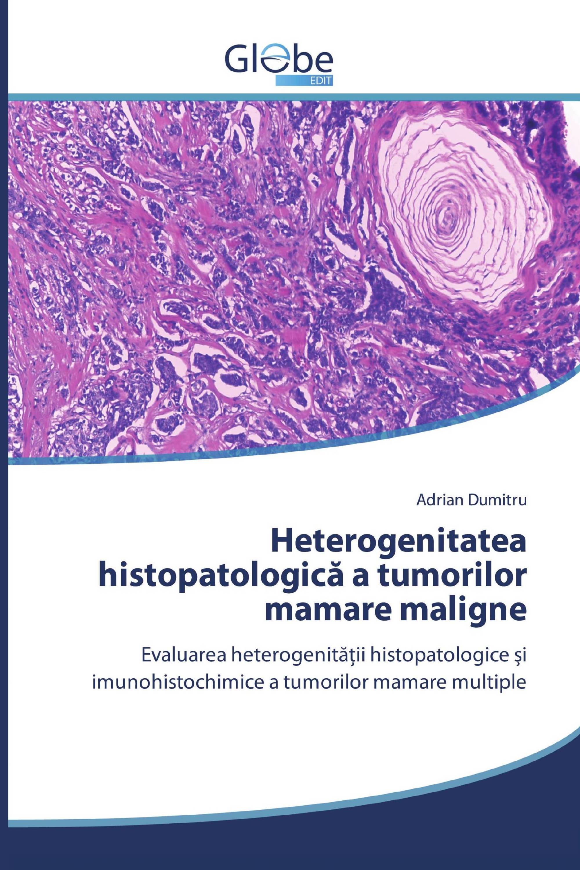 Heterogenitatea histopatologică a tumorilor mamare maligne