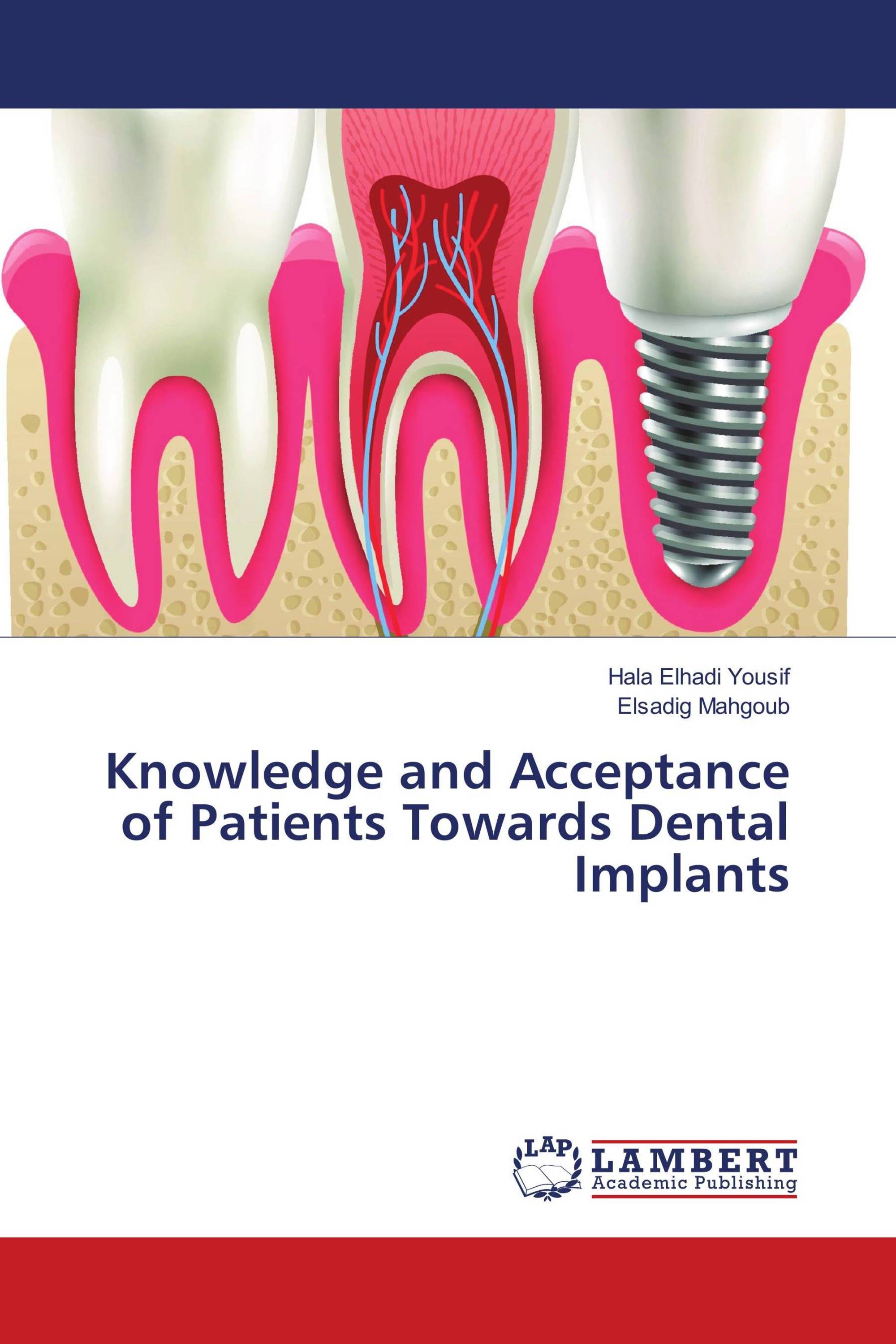 Knowledge and Acceptance of Patients Towards Dental Implants