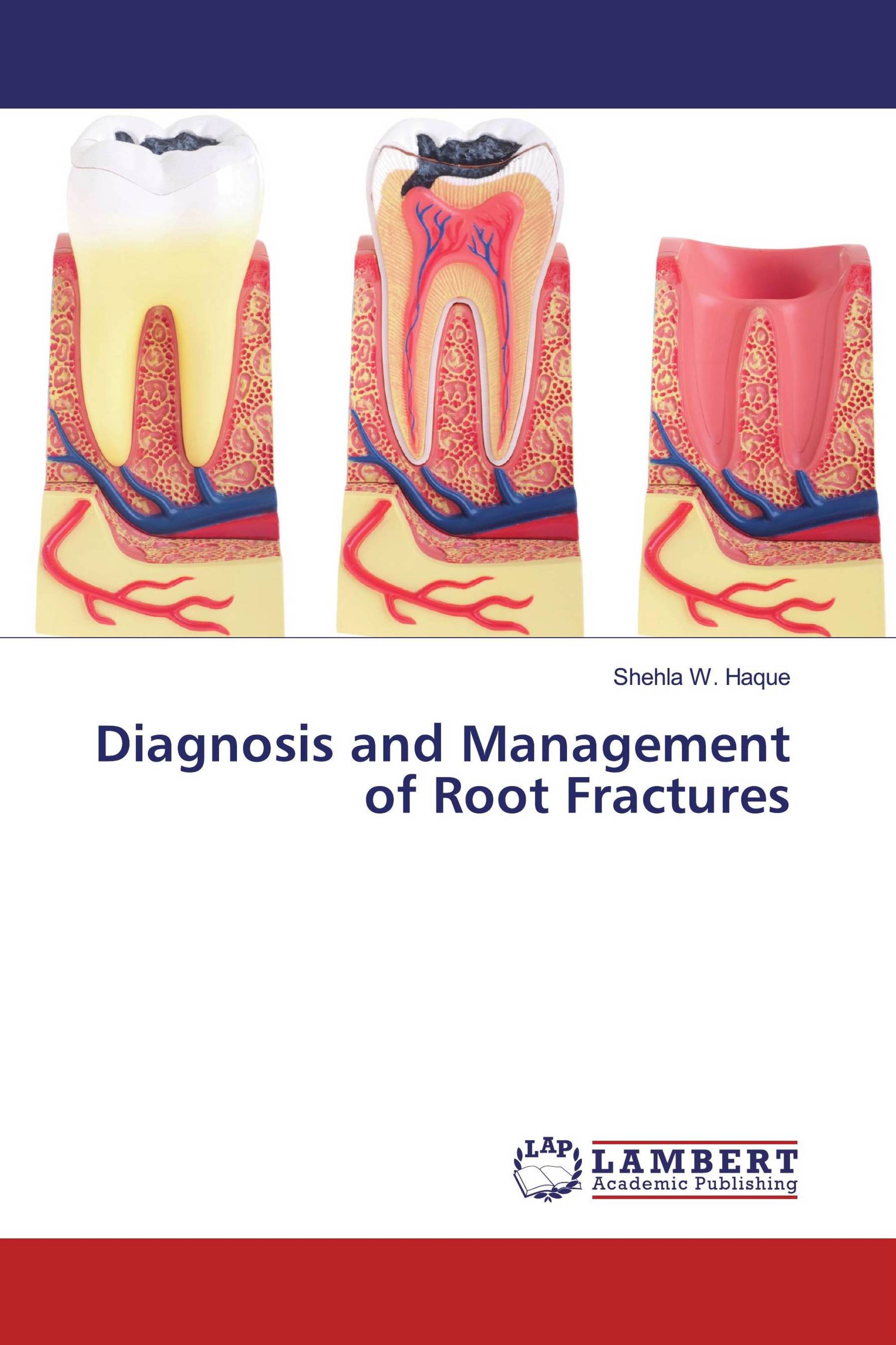 Diagnosis and Management of Root Fractures