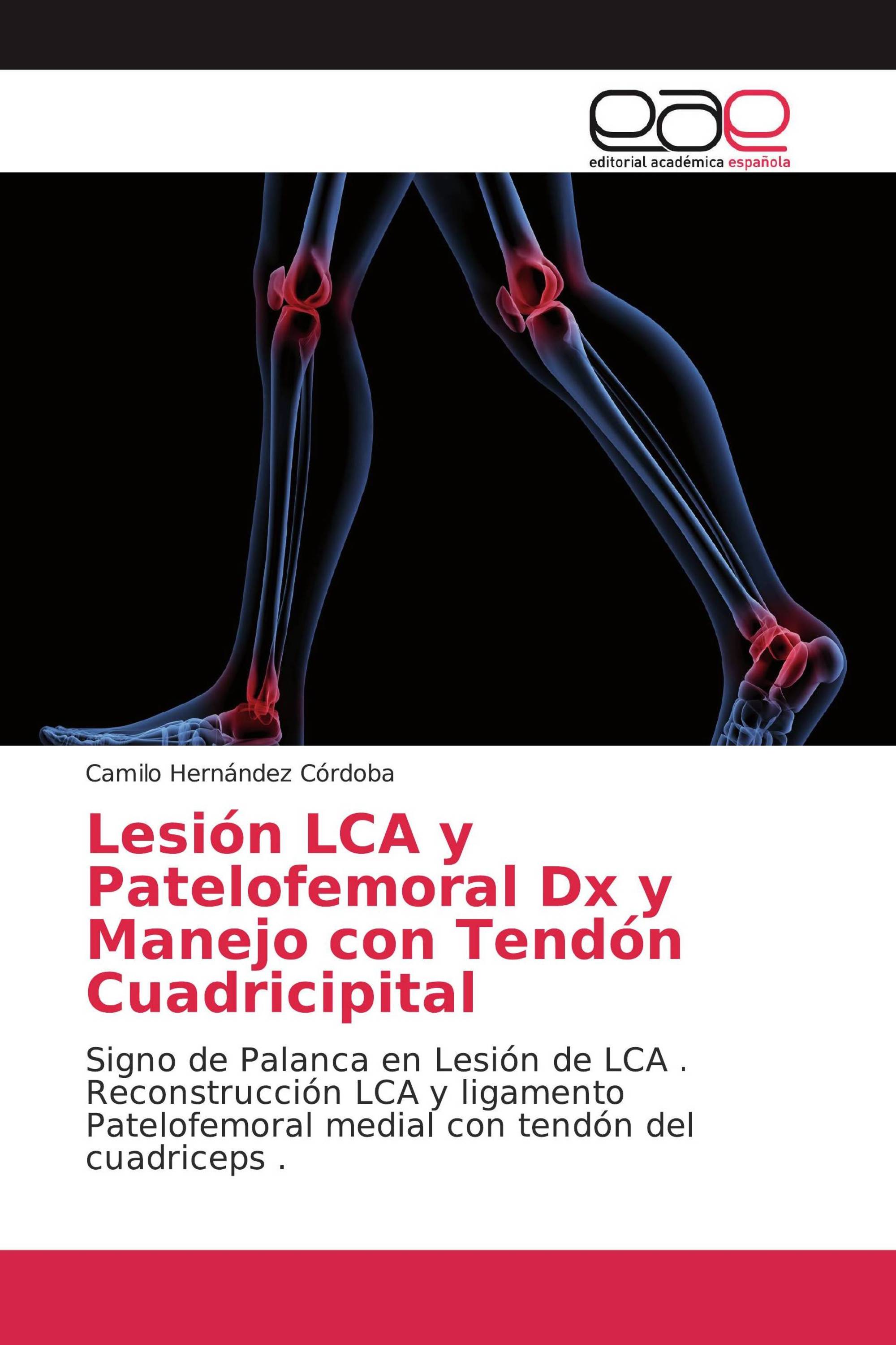 Lesión LCA y Patelofemoral Dx y Manejo con Tendón Cuadricipital