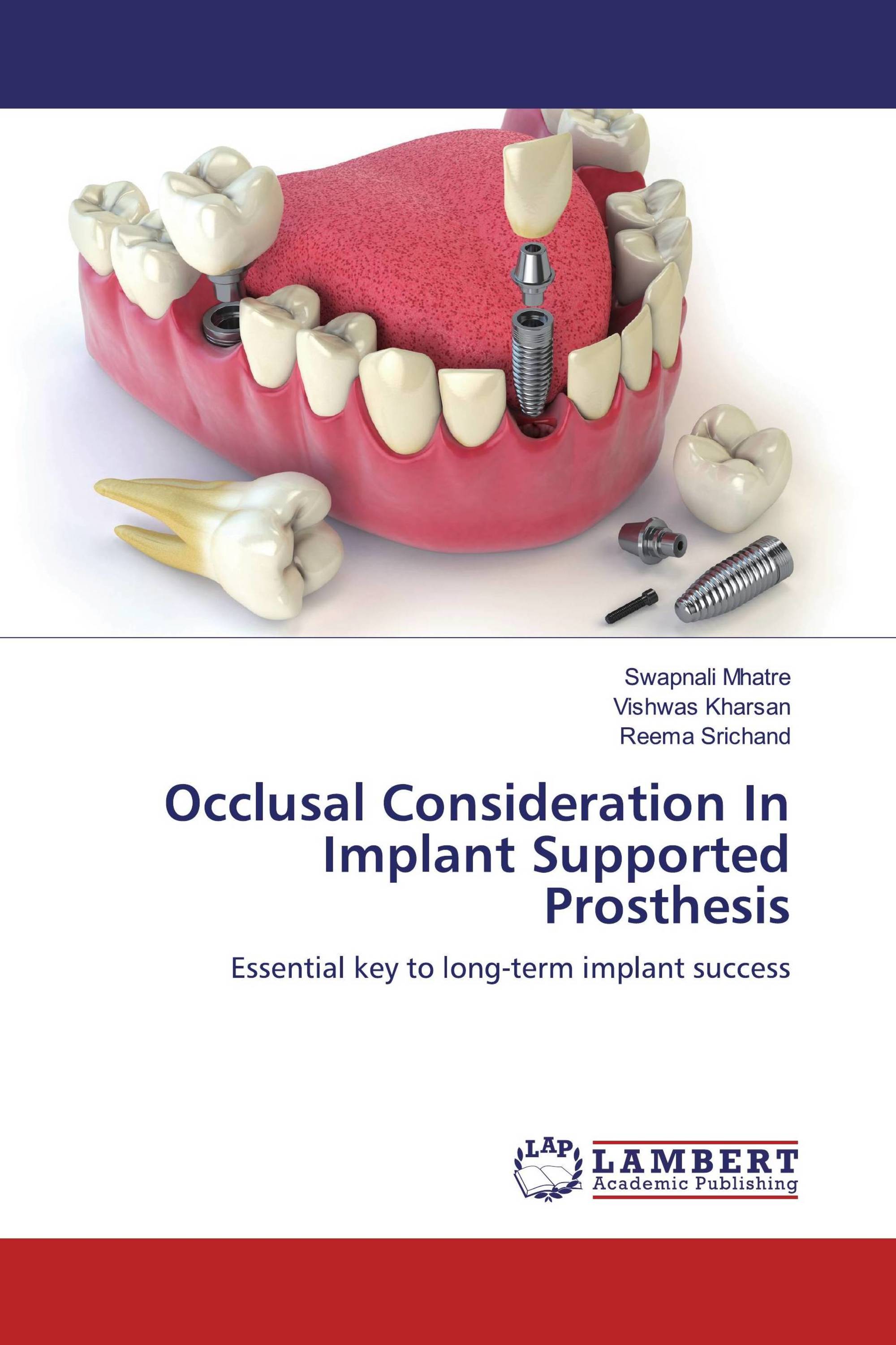 Occlusal Consideration In Implant Supported Prosthesis / 9786200