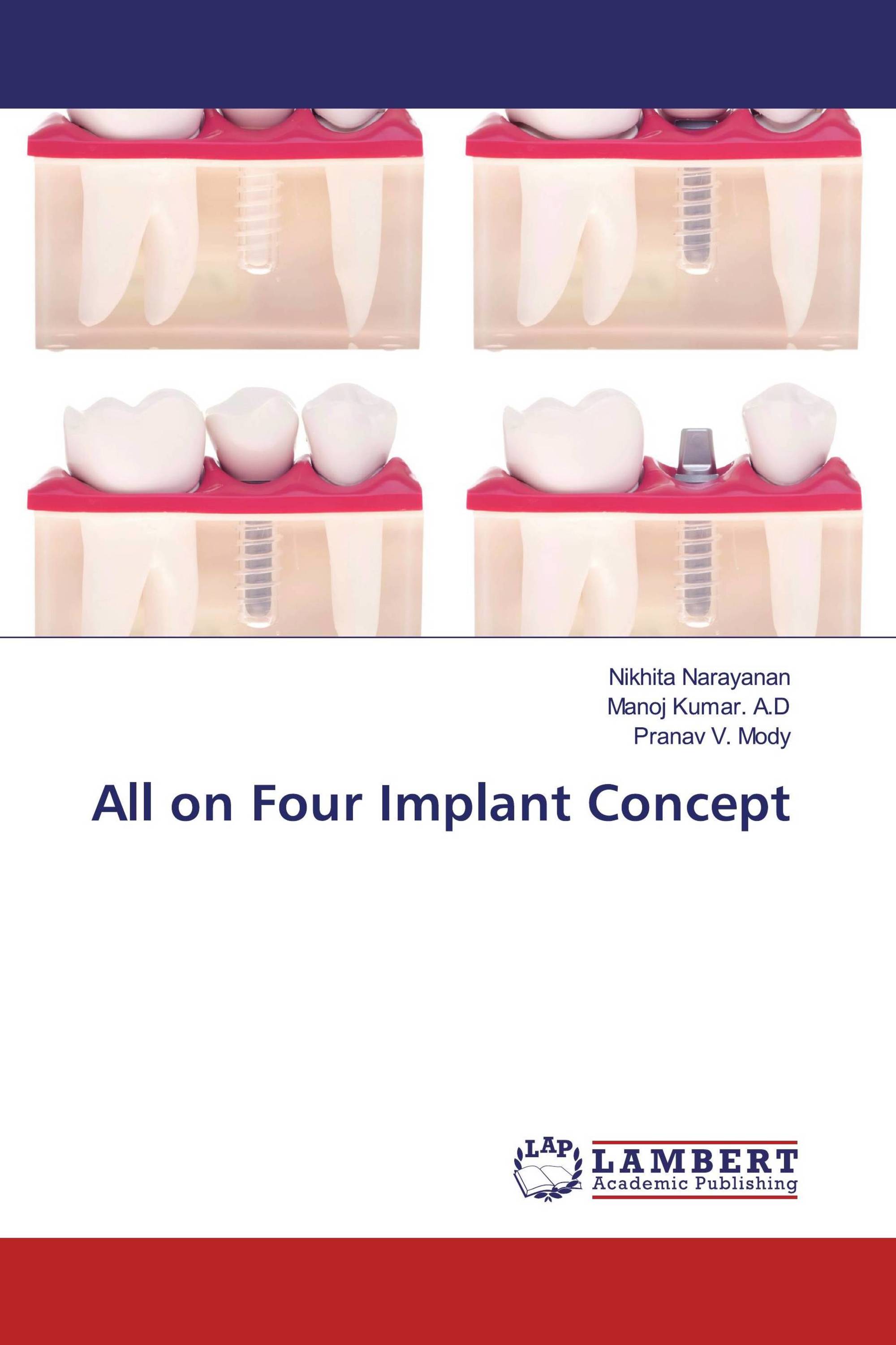 Implant supported prosthesis picture