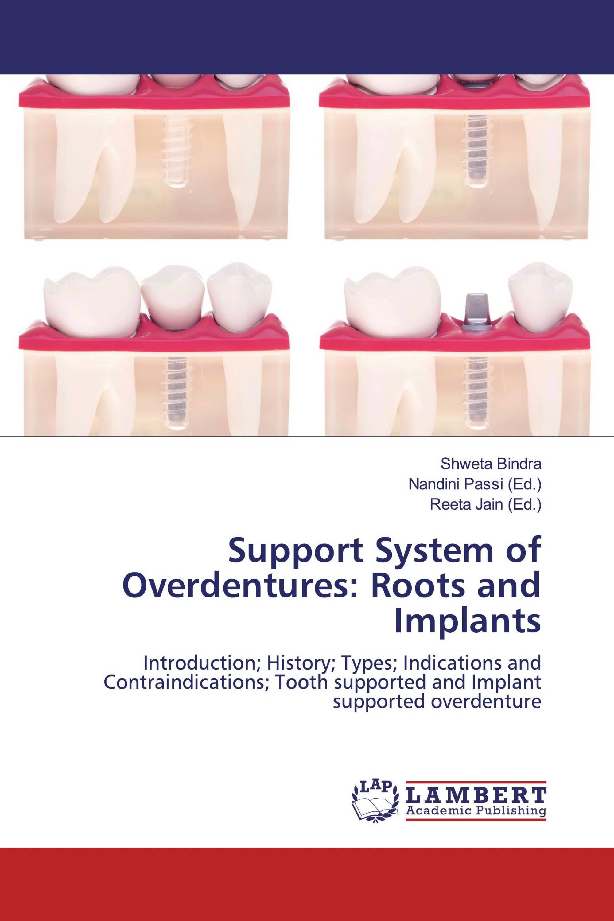 Support System of Overdentures: Roots and Implants